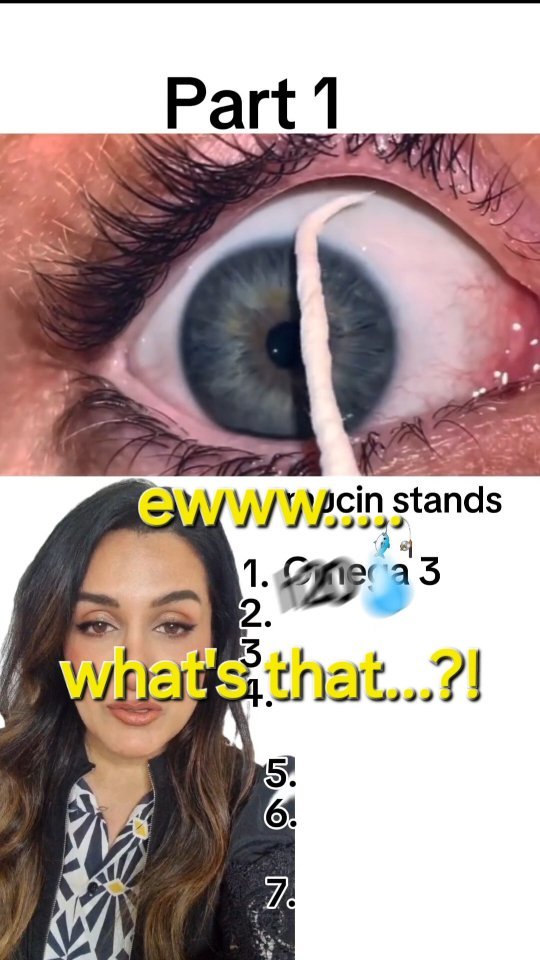 #eyeHealth READ THIS: Dry eyes can show in many ways and be caused by many factors. Here we look at these long mucin threads that form naturally in the eyes when the human tears break down due to a deficiency or weakness. Often taking an Omega 3 supplement (fish oil or flax seed oil for vegans) together with a dry eye drop and regular steaming of the eyes is enough to control this and stop the mucin threads forming.
/
Part 2 coming soon!
/
Dry eyes need to have the root cause found and controlled by an optical professional. Then treatment such as oral supplements/ vitamins, specialist dry eye drops, warm compresses and eyelid hygiene.
/
Do not go fishing like this, it can scratch the surface of the eyes and make it worse.
#tassuw #eyehealth #contactlenses #optician #optometrist #eyedoctor #healthfood #omega3 #healthyfats #diet #superfood #veganrecipes
