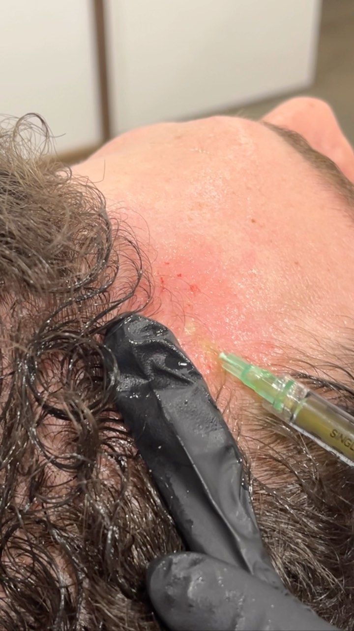 Platelet-Rich Plasma treatments at Dermalign π©΅β¨
.
.
#prp #prptreatment #vampirefacial #prpsunshinecoast #prphair #urbanlistsc