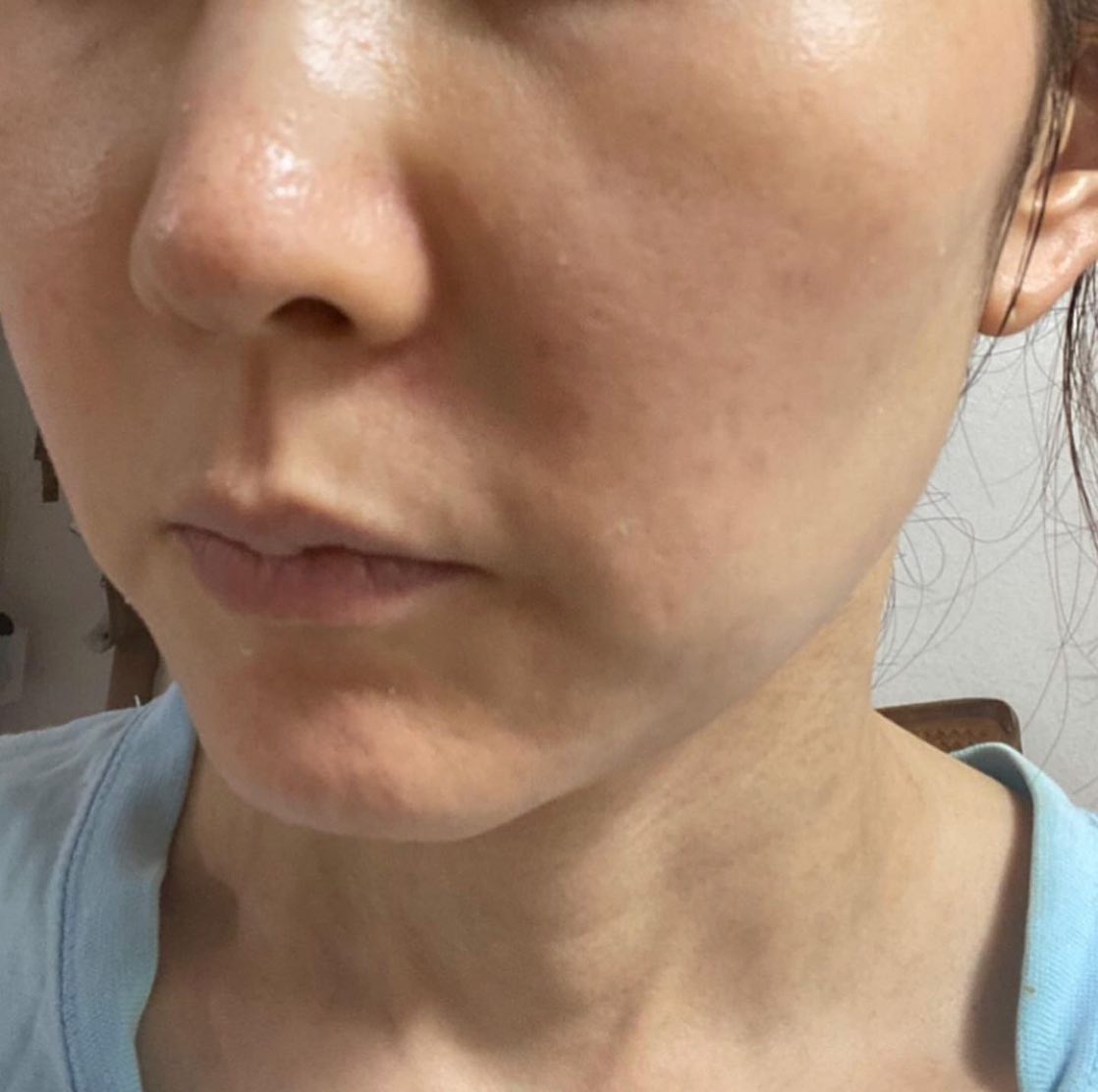 Amazing results!! These results were achieved with the Altum Peptide & Exosomes Treatment! ❤️ run and book your treatments 🥳