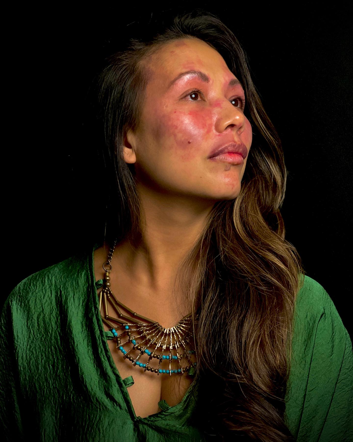 #portwinebirthmark #portwinestainbirthmark #portwinestainawareness #birthmarkpride #sturgewebersyndrome #pulseddyelaser #beautifullymarked