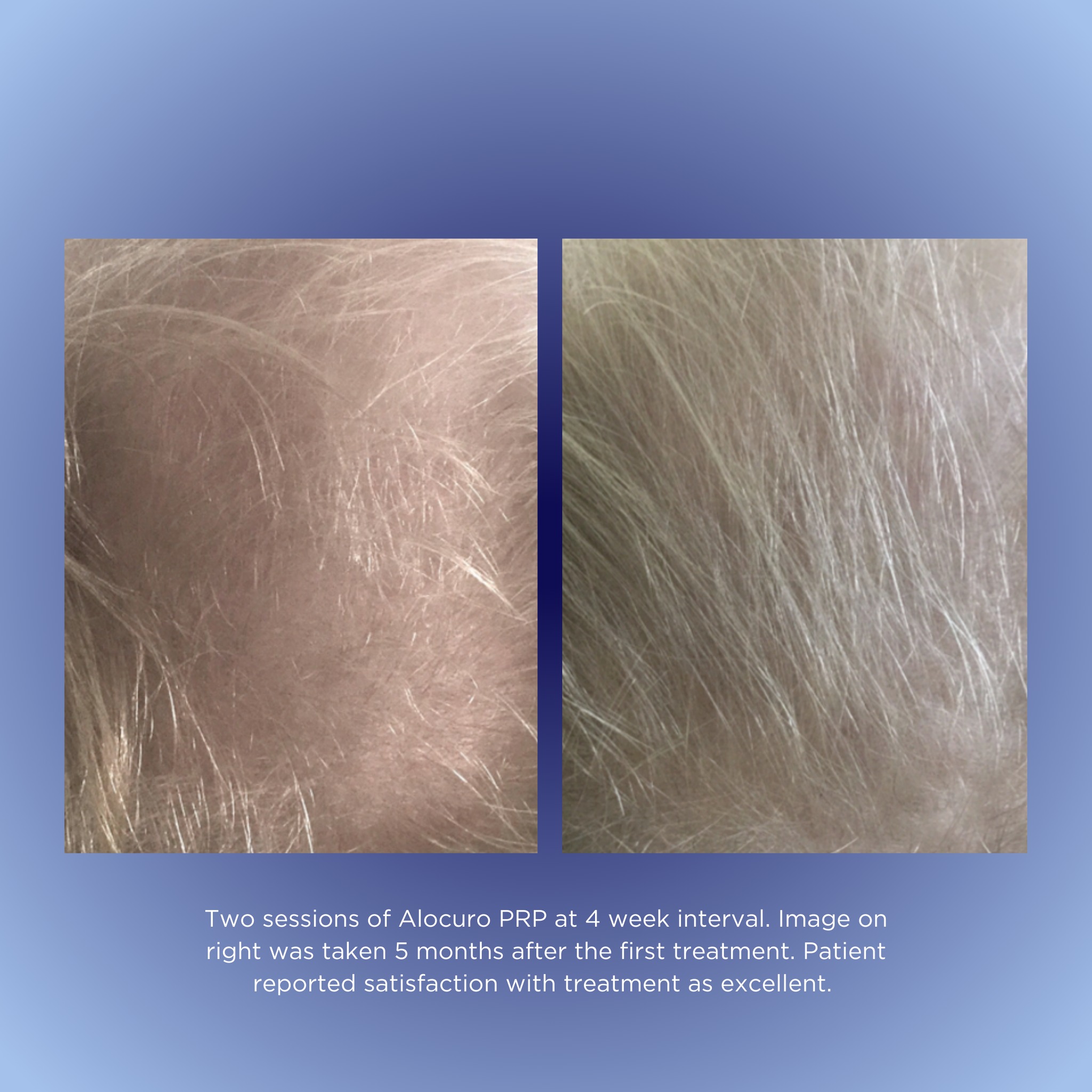 π Amazing growth! Embark on a journey from struggling to stronger hair today.
Results achieved by Dr Charles Phillis & RN Jennifer Roati
#BeforeMeetsAfter #DermalignMagic #HairTransformationTales
