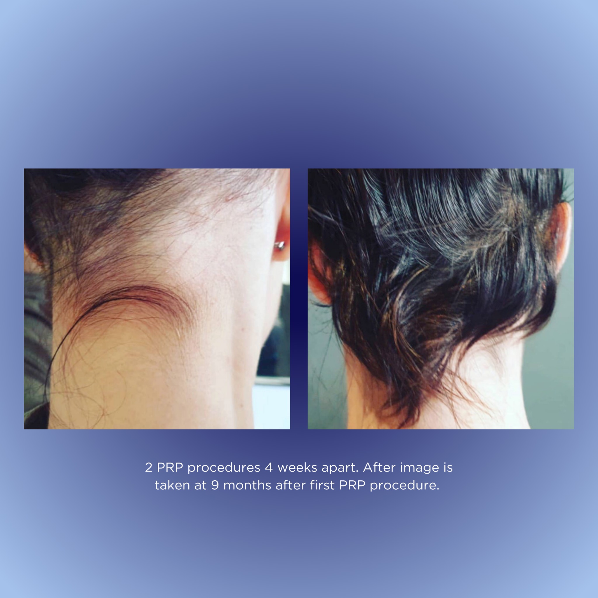 π Post PRP treatment! Dive into the transformative journey and watch your hair bloom anew. πͺπΈ
Results achieved by Dr Alex Ha & RN Nicole Hanna
#PRPProgress #DermalignPRPRevival