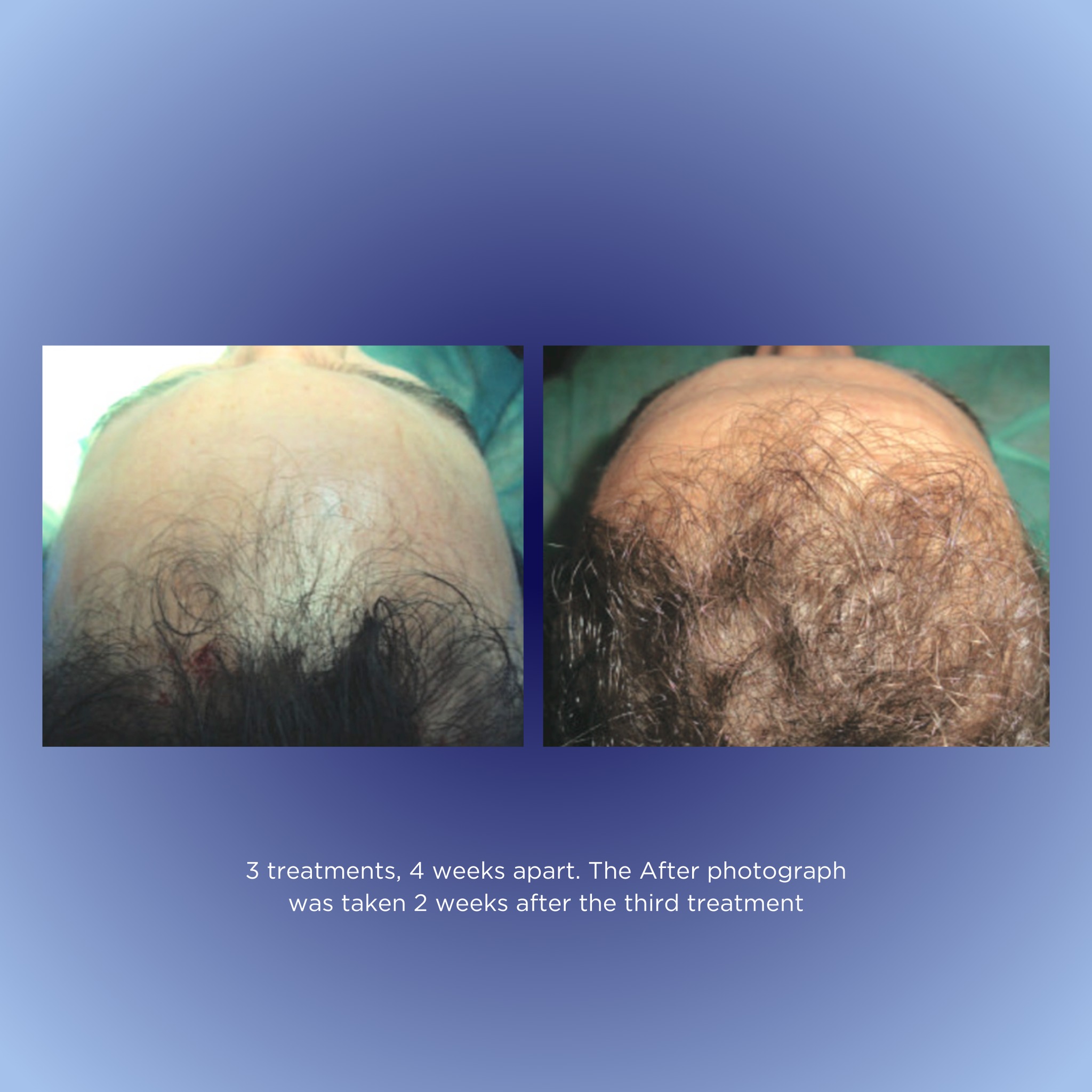 Look at this growth! See the transformation for yourself. Your hair journey could be next. πββοΈβ¨
Results achieved by Dr Cervelli and colleaguesβ (2014).
#DermalignTransformation #BeforeAndAfterGlow #HairRevivalJourney