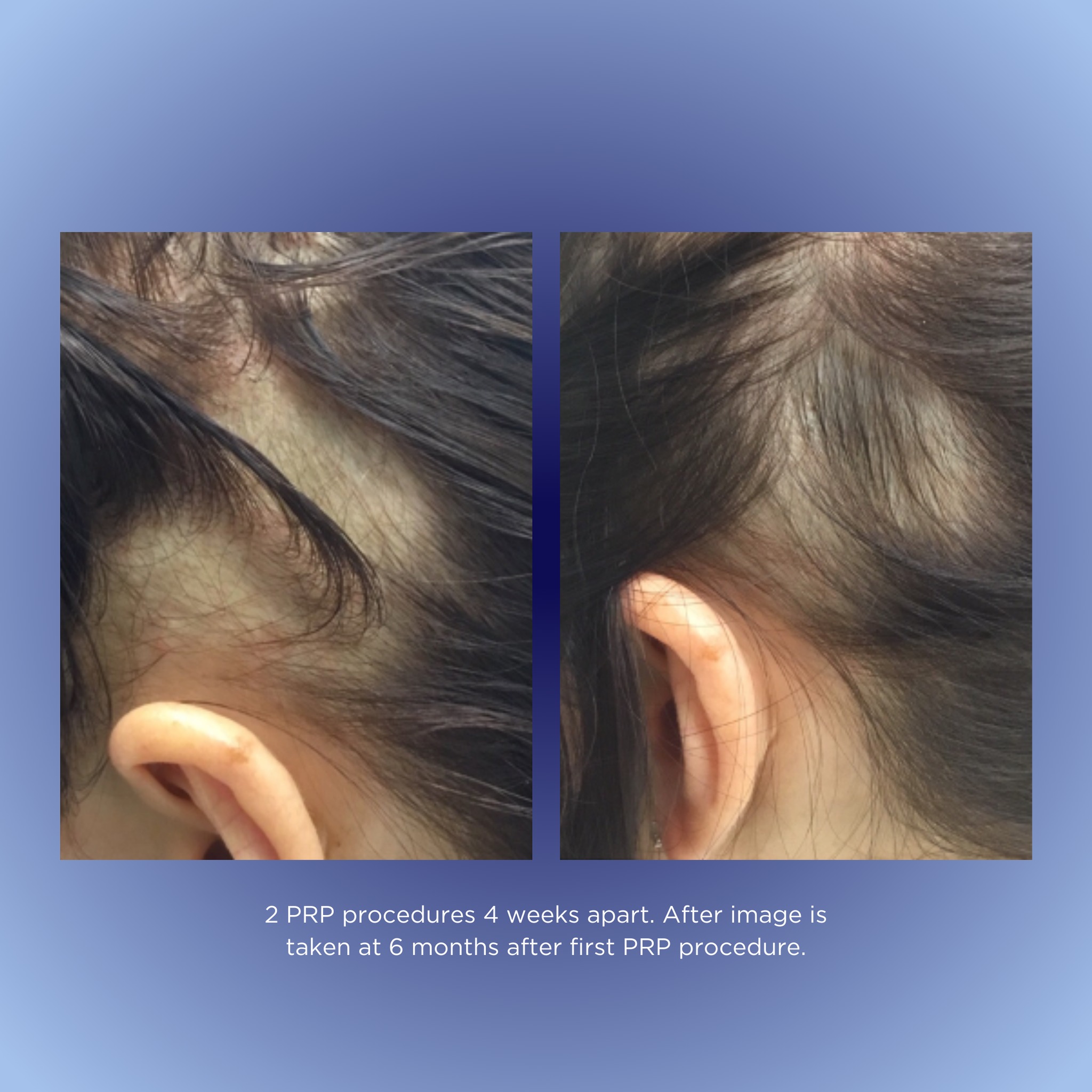 π©βπ¬Backed by science, driven by results. Dive deep into the innovative world of PRP solutions.
Results achieved by Dr Alex Ha and RN Nicole Hanna
#ScienceMeetsHair #PassionForFullness #DermalignInnovation
