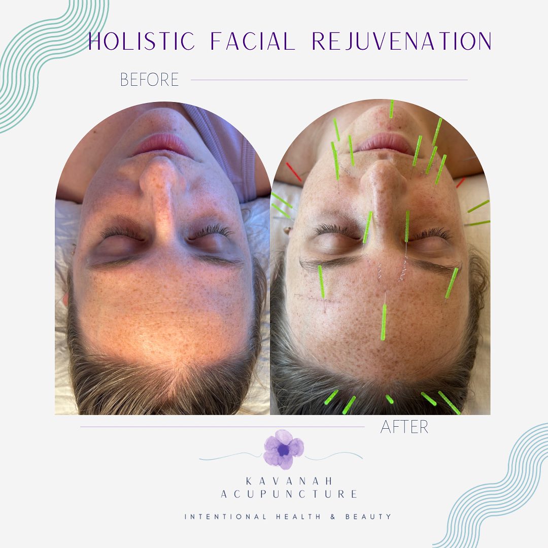 After five treatments, or if you ask @margotexplainsitall even sooner, you see the amazing reduction is fine lines and wrinkles! Here’s how holistic facial rejuvenation with acupuncture works:
🤍Qi & Blood flow: in Chinese Medicine, blockages or deficiencies or Qi (life force) and blood lead to dull, malnourished skin. We are renewing healthy circulation to the face to leave your skin looking brighter
🤍Acupuncture points: improve circulation, adjust muscle tone, and work with the bodies energetic meridians to revitalize the skin and muscle.
🤍Intradermal needling: microtraumas stimulate the bodies healing mechanism to promote collagen and elastin production. This improves skin texture and reduces the appearance of fine lines and wrinkles
🤍Gua sha massage: relaxes tight muscles, increases circulation, lifting technique to address sagging, lymphatic drainage to address puffiness. Everyone’s favorite part 💫
🤍Long- term results: just like with body acupuncture for wellness concerns, the effects of the treatments are cumulative. The more consistent you are with your treatments- the better the results ✨
#telavivacupuncture #wellnesstlv #holisticfacialrejuvenation #healthonpurpose #beautyfromwithin #notox