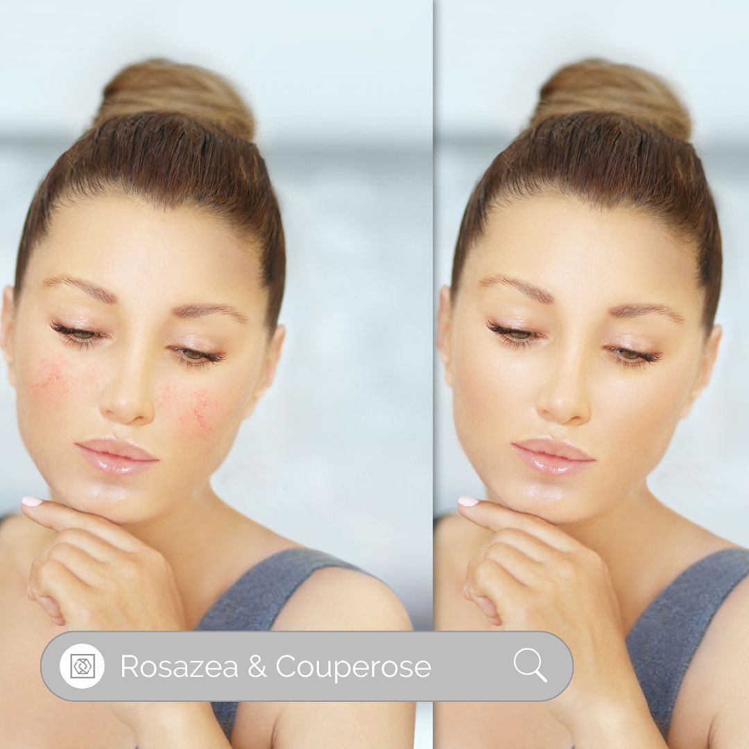 Liebe Hautpflege-Enthusiasten!
Wir freuen uns, euch mitteilen zu können, dass @hovellcosmetics mit der Kombination aus Creme und Serum eure Hautprobleme bei Rosazea und Couperose erfolgreich bekämpfen kann!
Die speziell entwickelte Formel zielt gezielt auf Rötungen und Irritationen ab, um euch eine beruhigte und ausgeglichene Haut zu schenken.
Mit regelmäßiger Anwendung werdet ihr spürbare Verbesserungen erleben - eure Haut wird ebenmäßiger, strahlender und gesünder aussehen.
#Hautpflege #Rosazea #Couperose #BeruhigteHaut #StrahlendeHaut