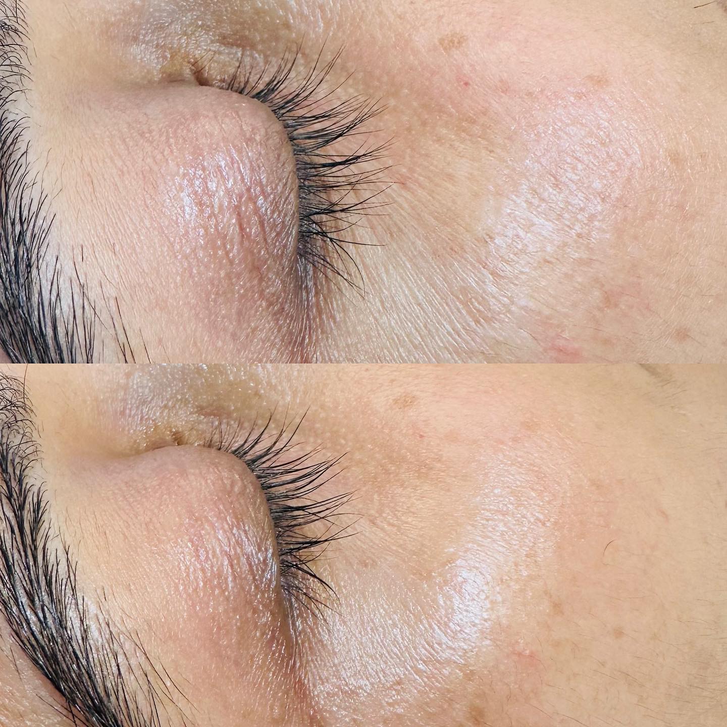 Before and after result Global Eyecon treatment for eyes , specially for anti aging dark circles, eye bag .#Mesoestetic#Grandeurbeauty#eyetreatment#drakcircles