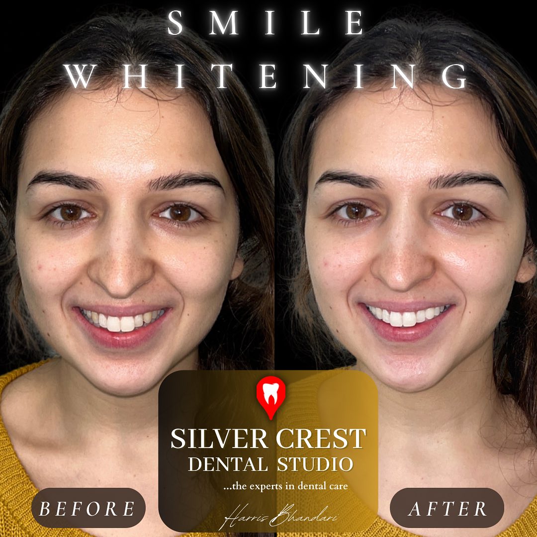 ‘Brighter smiles for new beginnings 🤍’
Our gorgeous patient, Ms S visited us a few days before her wedding, looking to elevate her already beautiful smile with our bespoke Silver Whitening Package ✨
60 minutes, no needles, no drills - just a magic of light to give a whiter, brighter smile instantly ✨💡
#whitening #teethwhitening #smilemakeover #transformationthursdays #smiledesign #instagram #explore #explorepage