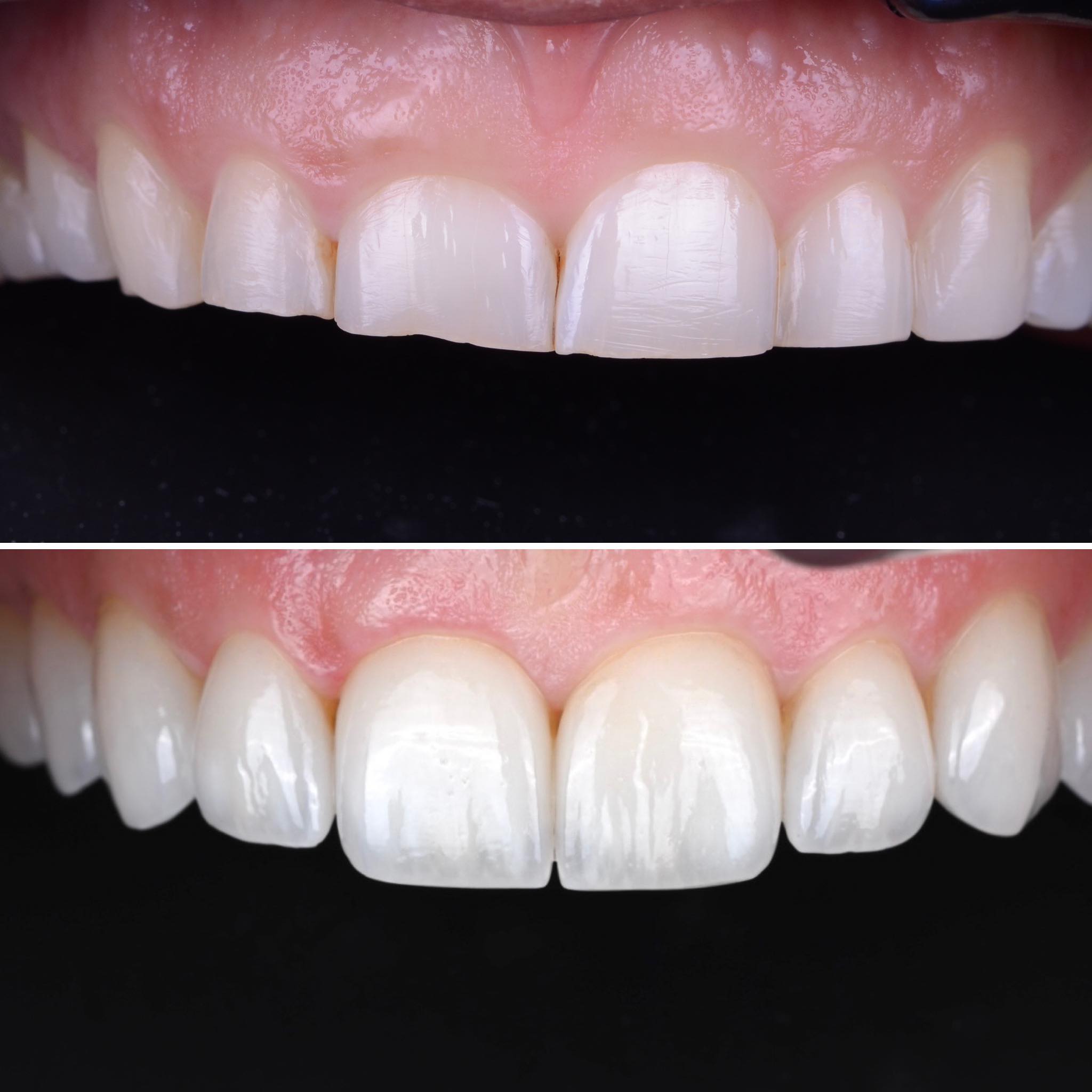 Extreme case of tooth wear (bruxism). The patients bite was treated first. Then the anterior teeth were reconstructed with porcelain veneers. #functionfirst #estheticdentistry #veneers