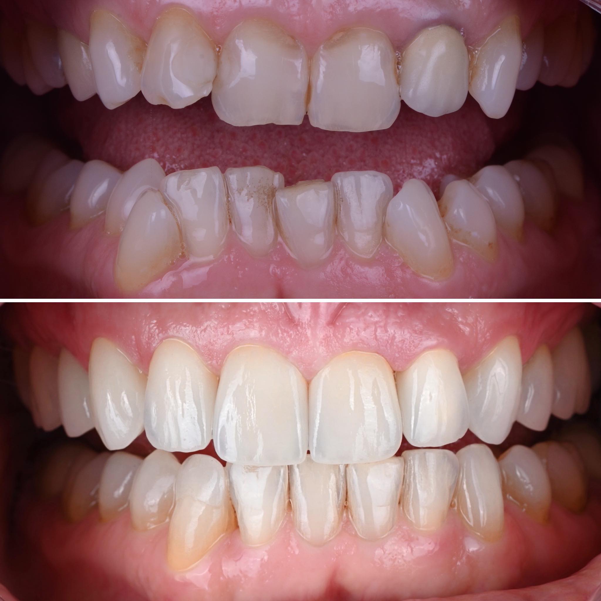 Full mouth functional and esthetic rehabilitation of a deep and constricted bite. #invisalign #porcelainveneers