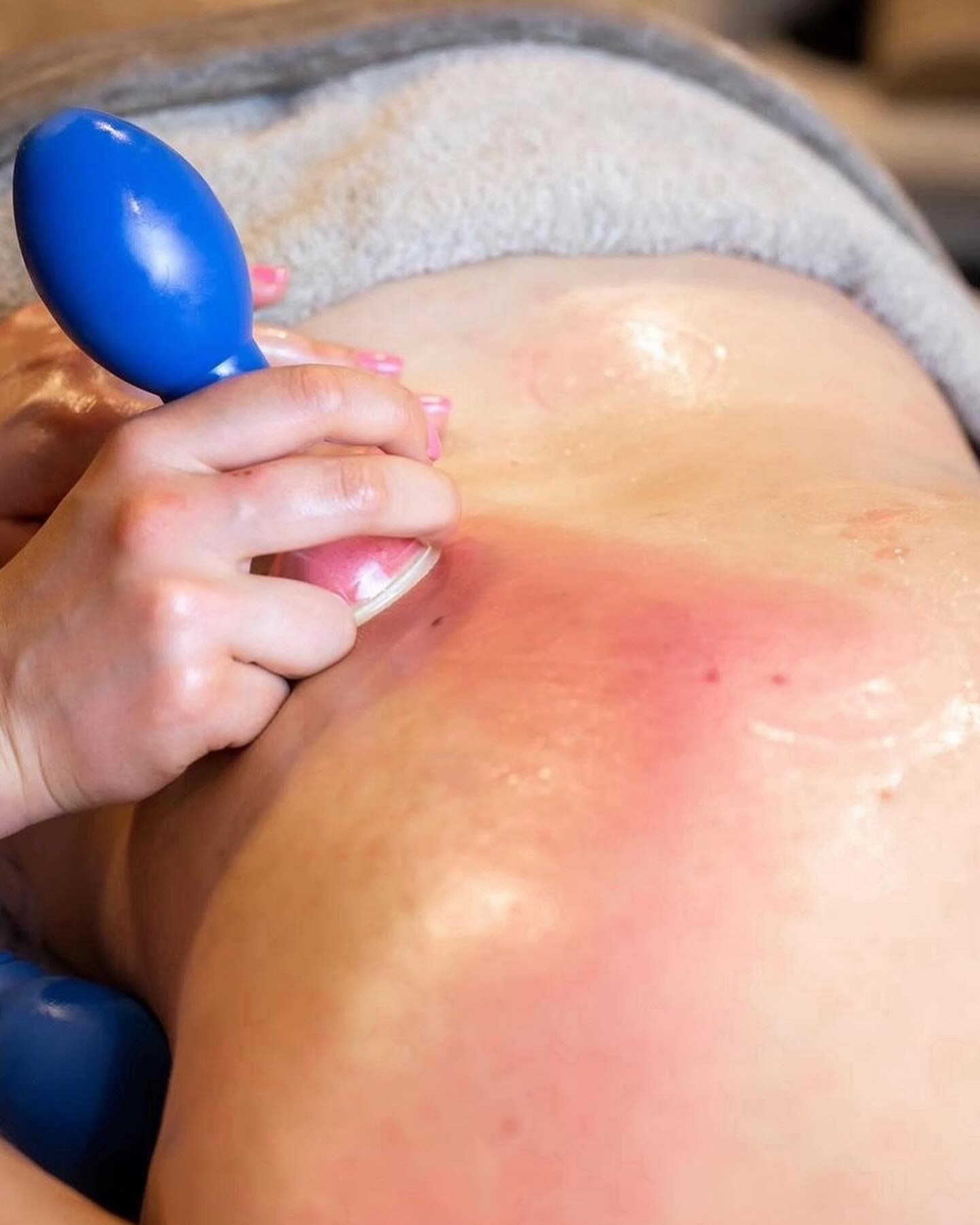 Mijn training voor Transformational Cupping Detoxing and Bodywork is afgerond.🎉
3 waardevolle en intense dagen waar ik wat over wil vertellen. 🙏
Ik had van te voren het idee dat cuppen voornamelijk wordt toegepast op cellulitis of nekpijn, uiteraard is dit zo maar oh hemel het wordt voor zoveel problemen ingezet.🍀
De behandelingen zijn zo divers en worden ingezet voor opgekropte emoties, stress, migraine, verklevingen , afvalstoffen, last van je darmen, last van je huid, het helder maken in je hoofd en het terug krijgen van je energie en nog zoveel meer. 🧚
Echt bizar, daarnaast hebben we het over de meridianen gehad en over de chinese geneeskunde. En uiteraard de boosdoener van (onze vaak slechte )voeding . 🍕
Deze dagen waren voor mij meer dan gewoon een cursus. Het werkt op alle lagen van het lichaam en is een geweldige behandelmethode waar ik veel mensen mee kan helpen.
Cuppen wordt op het hele lichaam toegepast maar ook op het gezicht dus zie dat als een intense bindweefsel behandeling. 🥰👍🏼
Vanaf volgende week ga ik deze behandelingen geven. Mocht je interesse hebben …let me know dan maken we een mooi behandelplan.😍
Ik ben uiteraard zelf ook veel gecupt en voel me emotioneel anders en erg rustig in mijn lijf. 🙏🥰