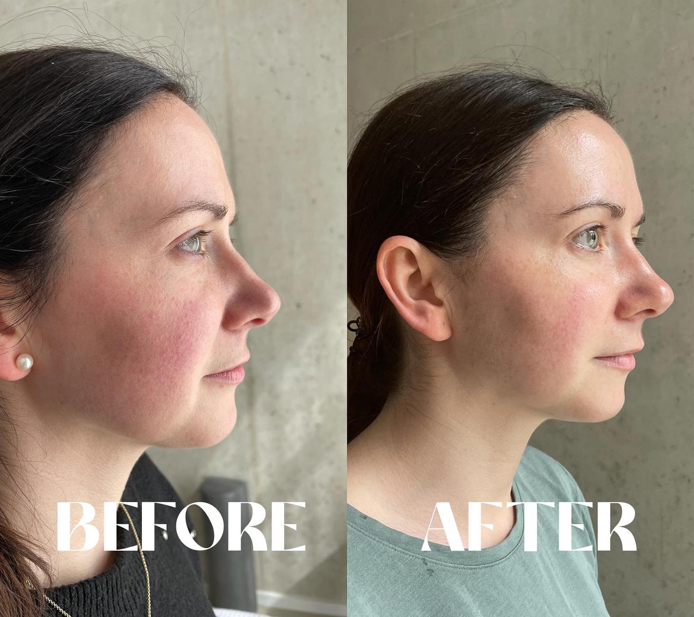 Beautiful results of our dear Anita✨
Led light therapy + Apivita cosmetics = happy skin🤍
The skin is visibly smoother, less red and irritated, and has a beautiful glow💋
Visit Le Sublime and let us be part of your skincare journey🫶🏼
#rosacea#sensitiveskin #amsterdam #ledlighttheraphy #skincare #happycustomer #wellness #apivita#ledlighttherapyamsterdam#ledlighttherapyspecialist