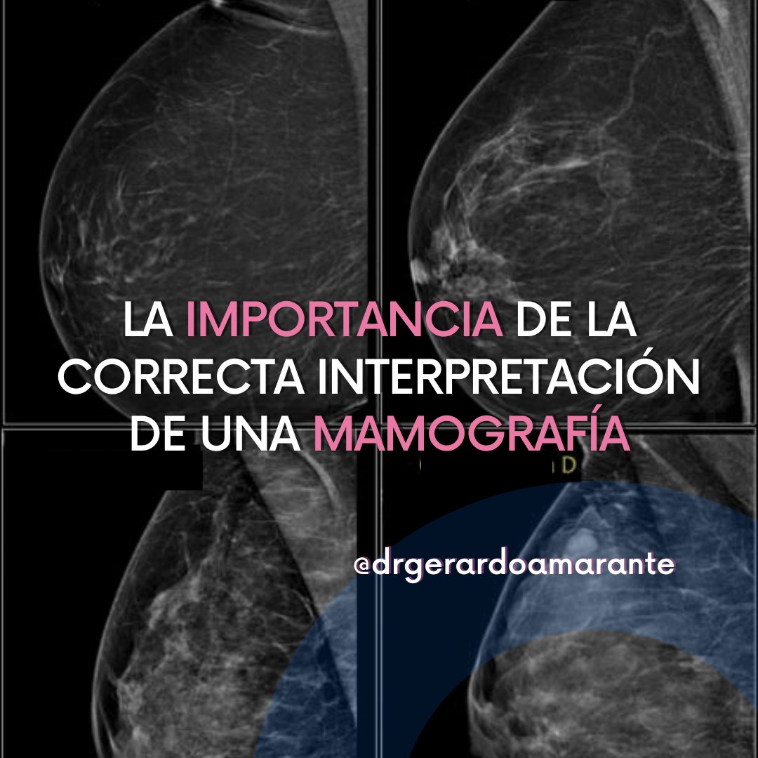 🧐¿Por qué es importante acudir siempre con personal calificado?
🫶La salud es un tema que no puede ser tomado a la ligera, en especial cuando se trata de la detección temprana del cáncer de mama. Como mastólogo, he sido testigo de la importancia de realizarse la mamografía en lugares adecuados y con especialistas calificados. 🩺
Muchas veces, los resultados mal interpretados pueden llevar a consecuencias graves. Por ello, te animo a no dejar tu salud en manos inexpertas. Ante la duda, busca siempre la opinión de expertos y acude a centros médicos confiables. Recuerda que un diagnóstico temprano puede marcar la diferencia en el tratamiento y recuperación.
Estoy aquí para acompañarte en este camino hacia la salud. 🌟
✨ Dr. Gerardo Amarante - Mastólogo
📞 Teléfono: 81 24 73 98 84
📲 WhatsApp: 81 81 61 72 62
.
.
.
#CáncerDeMama #Prevención #SaludFemenina #ConfianzaMédica #Seguimiento #LuchaContraElCáncer #Mastología #MujeresSaludables #MédicosEspecializados #BienestarFemenino #CalculoDeRiesgo #DrGerardoAmarante