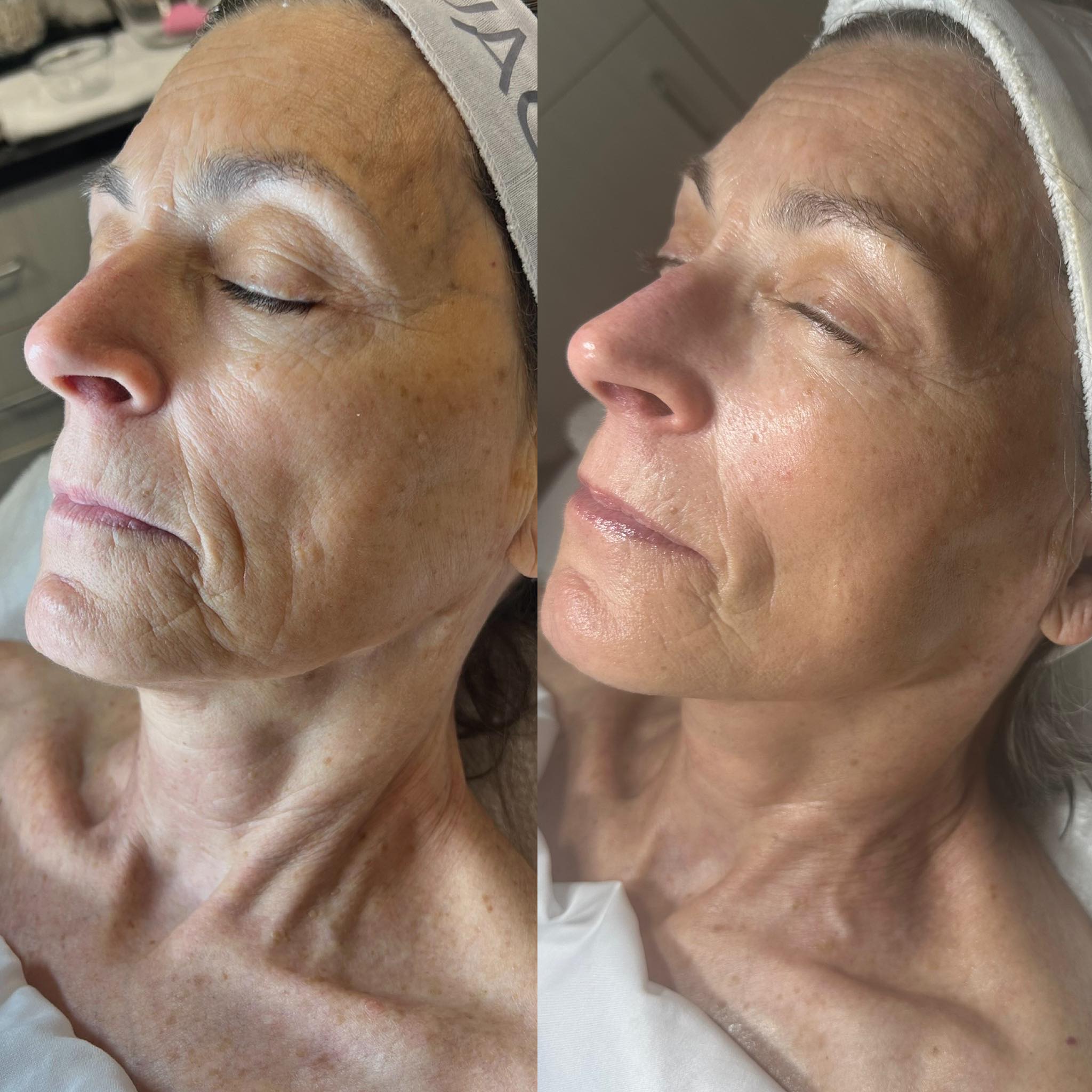 ✨Results within 4 months ✨ treatment plan… 2 Vivace Rf microneedling, 3 platinum hydrafacials and skin better skincare products!
#happyclient #vivaceexperience #hydrafacial💦
#skin better