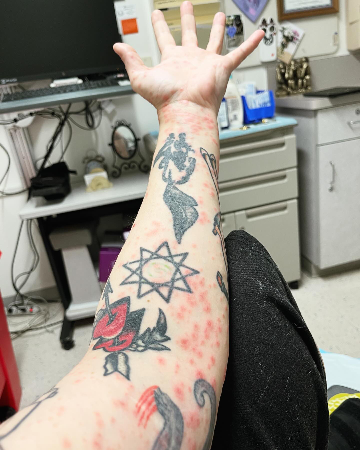 Got home and doing that healing business… but my body had other things in mind.
This popped up in 30 hours
#behcetsdisease