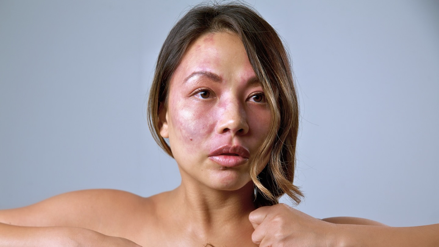 I have a bilateral port wine stain on my face and lower body, extending to both legs, and I’ve undergone more than 16 laser treatments over the years. Like many who have this birthmark type, some areas of mine may never fully fade. Yet, I’m a strong advocate for treatment , and regular screenings due to the medical and life-altering risks associated with this genetic mutation. I welcome stories from others with birthmarks and visibly unique skin – to me, it’s a reminder that Mother Nature is wild and we should celebrate our differences, showing that beauty can and always transcends conventional norms.