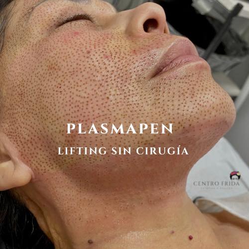 Plasmapen
LIFTING SIN CIRUGíA‼️
Sobre la técnica :
Punto por punto eliminamos parte del tejido excedente tratando cada una de las imperfecciones:
• Arrugas • Manchas • Líneas de expresión
• Levantamiento de párpados • Rejuvenecimiento de manos • Rejuvenecimiento de cuello.
• Mejora la Flacidez y estrías en abdomen
Los resultados son graduales y totalmente naturales.
✅ SIN DOLOR
✅ SIN CICATRICES
✅ SIN PINCHAZOS
Valoración GRATUITA‼️
Escríbenos para mayor información ☺️
Centro Frida 🌸🌺🌼
Estética & Belleza
Whatsaap 📲624252194
••••••••••••••••••••••••
#plasmapenmadrid #dermapenmadrid #esteticamadrid