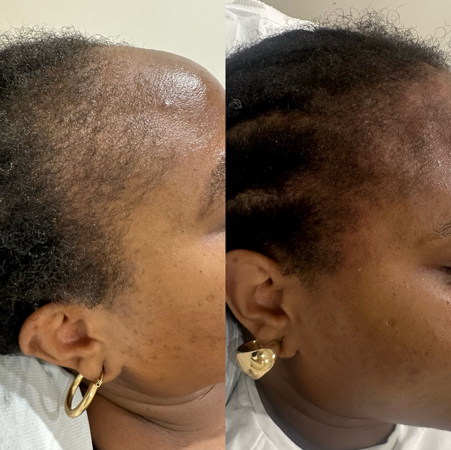 Dr. CYJ Hair Filler is an injectable treatment designed to address hair loss and promote hair growth. It is formulated with a blend of peptides and hyaluronic acid. Here’s a summary of its key components and benefits:
Key Components:
1. Peptides:The filler contains several peptides that aim to stimulate hair growth, strengthen hair follicles, and improve blood circulation to the scalp.
2. Hyaluronic Acid:This helps in hydrating the scalp and creating a suitable environment for hair growth.
Benefits:
- Promotes Hair Growth: The peptides in the formula help in revitalizing hair follicles and stimulating new hair growth.
- Improves Scalp Health: Hyaluronic acid provides hydration, improving the overall health of the scalp.
- Reduces Hair Loss: By strengthening hair follicles, it helps in reducing hair shedding.
- Enhances Hair Density and Thickness: Regular treatments can lead to thicker and denser hair over time.
Procedure:
- The treatment is administered via microinjections directly into the scalp.
- Typically, a series of 4 sessions is required to achieve optimal results, often spaced 2 weeks apart.
- The procedure is minimally invasive with minimal downtime.
Suitability:
- Suitable for both men and women experiencing hair thinning or hair loss.
- Often recommended for individuals with androgenic alopecia or other forms of hair loss.
Safety and Side Effects:
- Generally considered safe with minimal side effects.
- Possible side effects include mild swelling, redness, or tenderness at the injection site, which usually resolve within a few days.
#hairgrowth #hairgrowthtips #hairgrowthjourney #beauty #courses