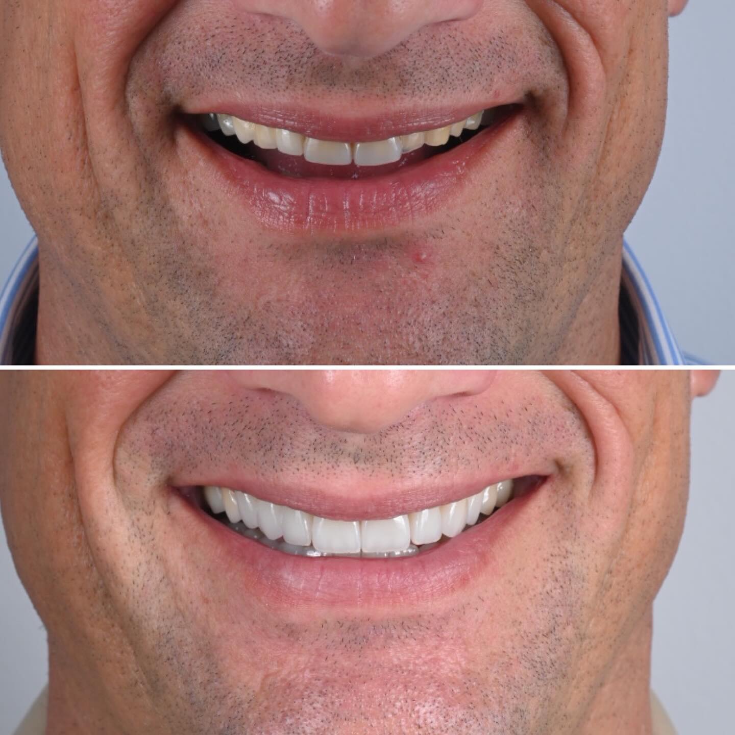 Another functional and aesthetic full mouth rehabilitation: Check out the patient’s facial picture to see the real impact teeth can have on facial expression. Patients seeking cosmetic procedures often focus on other treatments, underestimating the profound effect a beautiful smile can have on overall beauty. This picture is posted with the explicit consent of the patient. #fullmouthreconstruction #dentistry #oralhealth