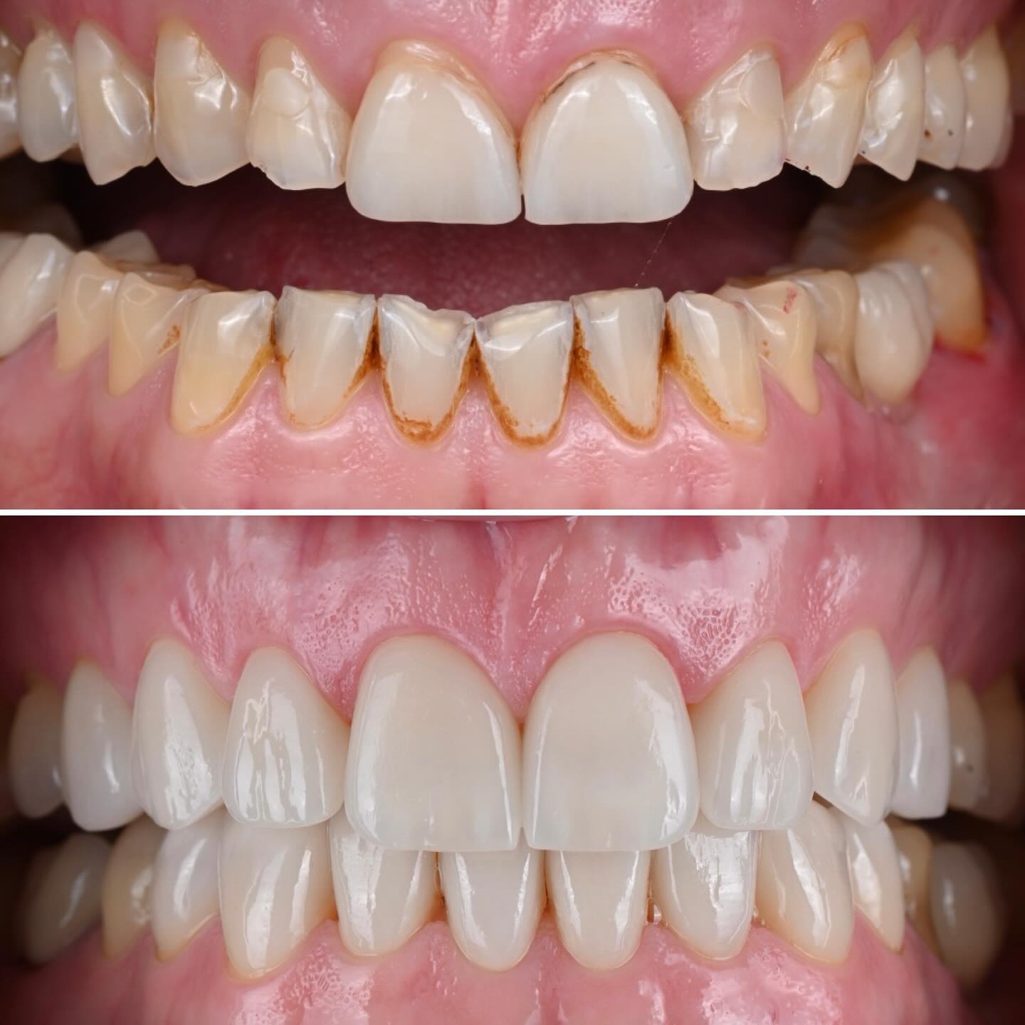 Full mouth rehabilitation of a worn dentition: This young patient had severely worn teeth due to erosion from energy drinks and bruxism, leading to extreme sensitivity and rapid breakdown. Ideally, preventative measures taken ten years ago could have avoided these dramatic consequences. Unfortunately, the focus on prevention and longevity in dentistry has been insufficient. Now, we had to restore all the teeth using minimally invasive ceramics, the best approach to recreate a stable oral environment. In the past, crowns were commonly used, but we now know they can weaken teeth, cause more complications, and have a shorter lifespan. #preventionandlongevity #oralhealth #estheticdentistry