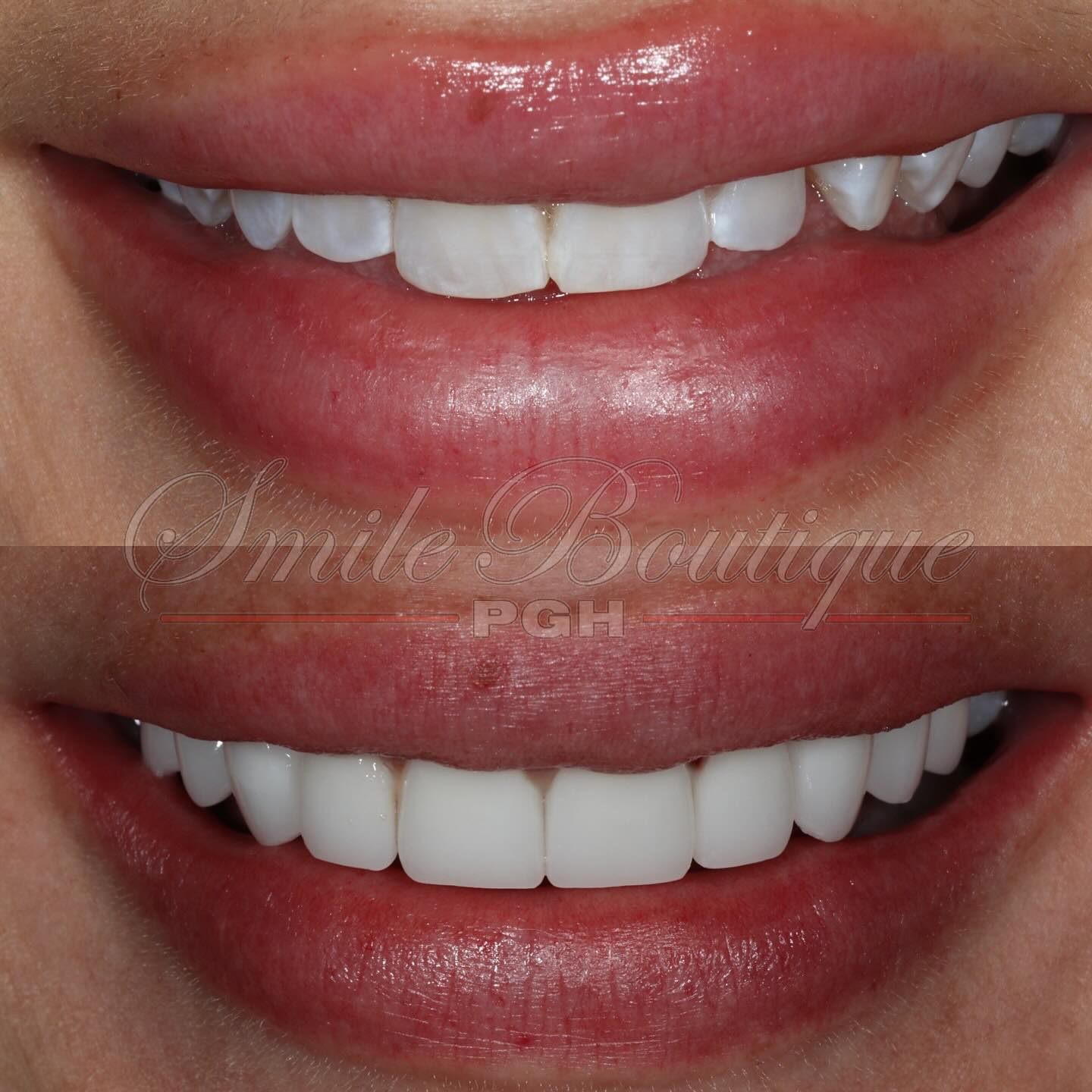 Monday Motivation 🤩
Featuring Ms. @nicholefreedom’s smile transformation 🙌
Her dislikes (✖️) & what we achieved (✔️):
✖️ Small teeth
✖️ Tooth sticking out
✖️ Uneven size teeth
✖️ Blotchy teeth
✖️ Crooked teeth
✖️ Slanted smile
✔️ Balanced Smile
✔️ Brighter smile
✔️ Straighter teeth
✔️ Fuller smile
✔️ More teeth show
Procedure prescribed:
1️⃣ Top - 10 units of Lithium Disilicate veneers
Nichole wanted her smile done for a long time as it was something that she always had concerns about especially her one tooth that stuck out. We were introduced by @micah1344. After researched and connected with multiple cosmetic dentists around the country for years, she chose me for her transformation 🙏
End result = another happy confident smiling patient 🤩
To learn more on how to get your winning smile, schedule your consult with link in bio.
#winning #winningsmile #mondayvibes #mondaymotivation #mondaymood #newsmile #sopretty #justwow #soamazing #smilemore #confidentwomen #confidence #confidentlybeautiful #confidentsmile #smiletransformation #smilemakeover #teethwhitening #pittsburghdentist #cosmeticdentistry #cosmeticdentist #topdentist #aacd #happypatient #anotherone #anotherhappycustomer #luxurylifestyle #treatyoself #lifechanger #changinglives