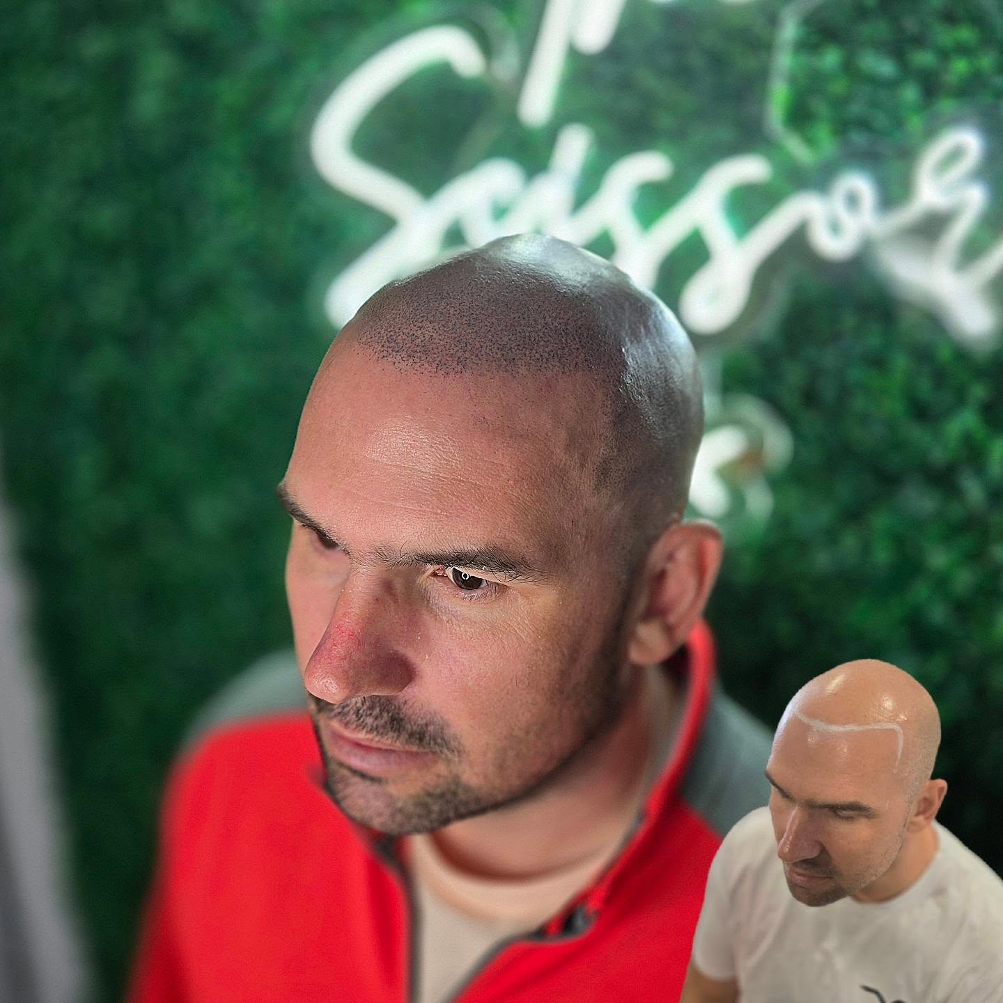 SMP TRANSFORMATION
Full head treatment over 3 sessions! Huge transformation!
Scalp Micro-Pigmentation for hair loss is the best affordable, low maintenance hair loss solution with instant results!
Enquire now for more detail about the cosmetic treatment
🕸www.skinheadstudios.co.uk
📧 skinheadsmp@gmail.com
📍Bury St Edmunds, Suffolk
⭐️5 star Google reviews