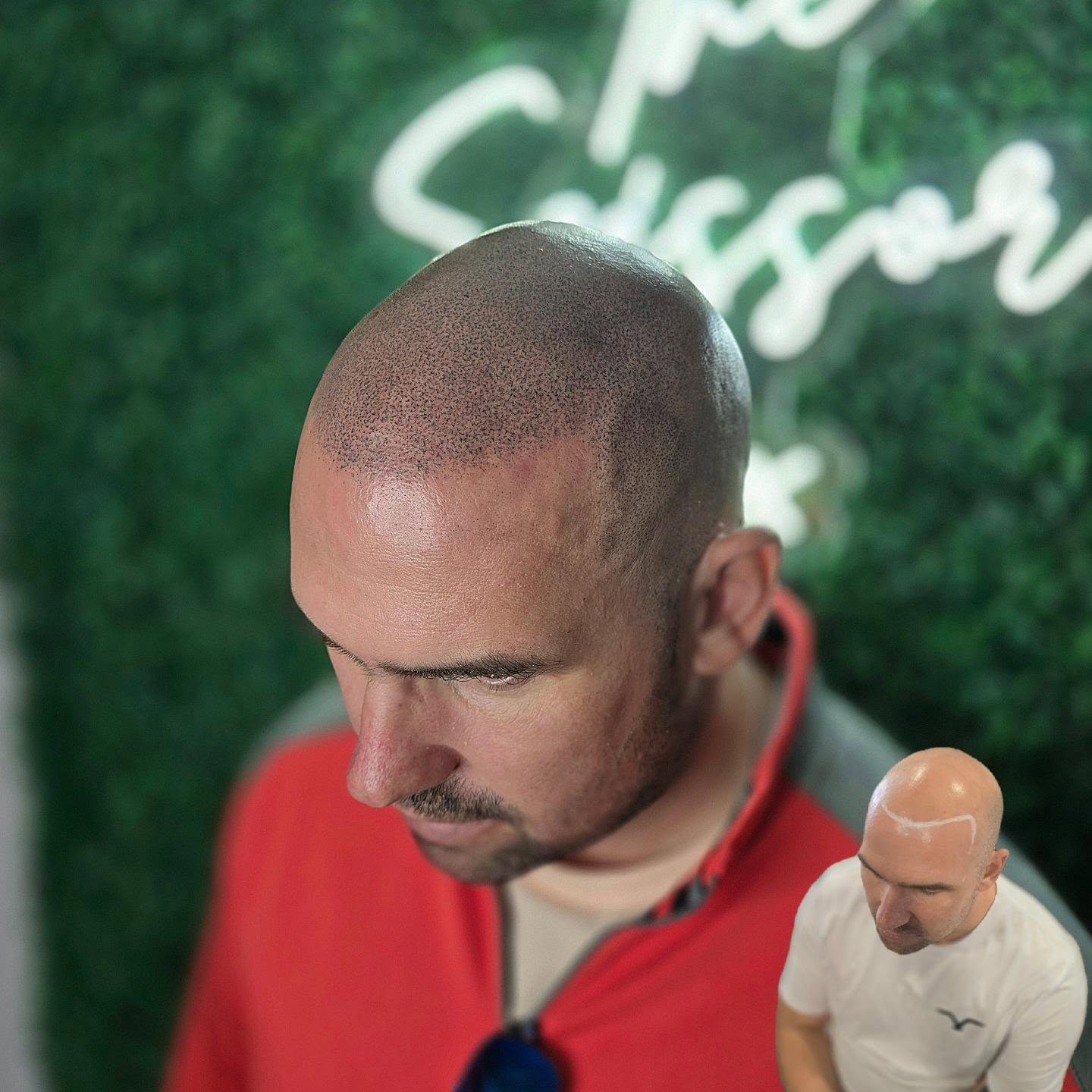 HAIR TATTOO?!
Scalp Micro-Pigmentation is the best hairloss solution available. FACT.
- Hyper-realiatic results, everyone believes its real hair shaved down
- Results from the first session, subtle at first and density build gradually each session (unlike a hair system)
- Typically only 3 sessions needed, over 2-4 weeks, takes around 2 hours each time (far less arduous than a transplant)
- Far more cost effective than any other hair loss solution; e.g transplant, PRP or hair system
- Guaranteed results!
- Extremely low maintenance (unlike a hair system)
- Applicable to anyone at any stage of hair loss
📍Bury St Edmunds, Suffolk
🕸www.skinheadstudios.co.uk
Get in touch today for a free consultation to see how SMP can help you solve your hair loss!
Using @valknutrotary