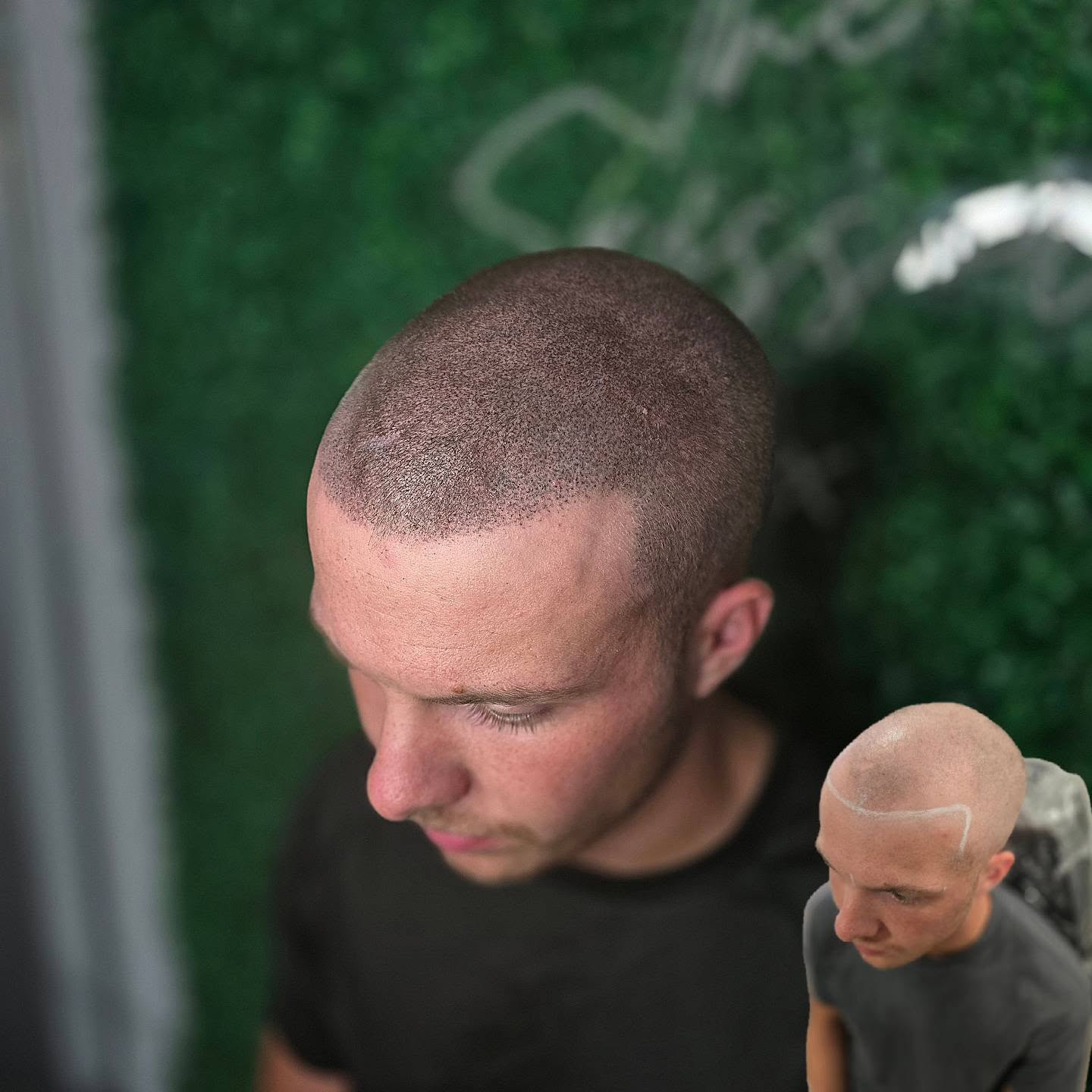 SCALP PIGMENTATION
Cosmetic tattoo to replicate hair follicles to disguise a receding hairline
One of the most effective hair loss solutions because it doesn't actually involve any hair; guaranteed results from the first session!
Affordable hair loss solution, no surgery or medication involved
Enquire today to see how SMP can help you solve your hair fall
📍Bury St Eds, Suffolk & Brighton Clinics
BUY NOW PAY LATER SCHEMES AVAILABLE
#smp #scalppigmentation #scalpmicropigmentationtraining
#scalpmicropigmentation #hairregrowthtreatment
#hairreplacement
#hairrestoration #hairrepair #hairregrowth #hairloss #hairlosstreatment #hairlosshelp #hairfall #hairlove #hairlife #hairlosssolution #buzzcut #shavedhead #hairtattoo #scalptattoo #smpartist #baldfade #bald #recedinghairline #balding