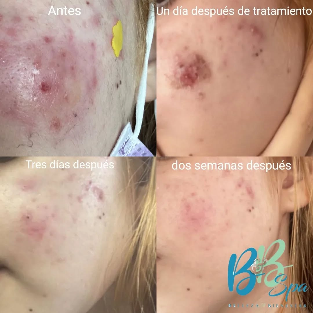 Nuestro tratamiento de factor de crecimiento no sólo ayuda a reafirmar y a retrasar los signos del envejecimiento además es un excelente regenerador de tejidos o lesiones ,algo que lo hace verdaderamente diferente es que este regenera tejido de manera tópica e interna, completamente rapido y eficiente !!!
.
.
.
.
El tratamiento fraccionado es lo de HOY !!!
Ayuda a combatir y eliminar :
•Arrugas
•Flacidez
•Acné
•Quemaduras
•Marcas de acné o estrías
Pregunta por nuestros paquetes consulta de evaluación GRATUITA
Llama YA! O envíanos WhatsApp 📲 al 6461856062
Ubicados 📍en macroplaza del mar en interiores de lipstick salón 💄
#luce&sientetebien✨️👍✔️