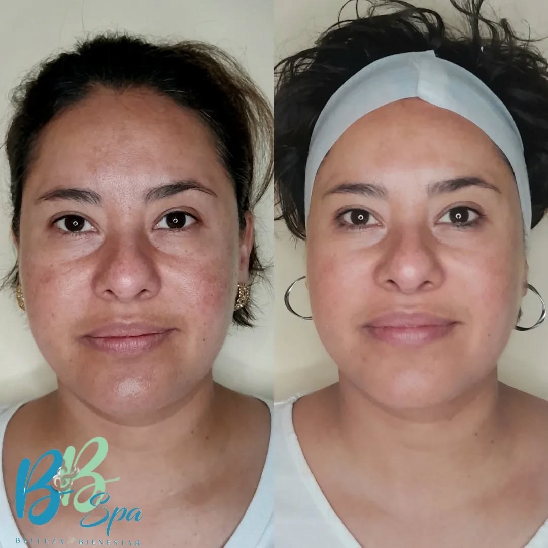 Procedimiento fraccionado, evolución real de nuestra paciente a tres sesiones de las cuatro que incluye nuestro paquete !!!
Regenera,reafirma y rejuvenece ,sin dolor ni cuidados posteriores complicados
El tratamiento fraccionado es lo de HOY!!!!!!
.
.
.
Para citas de evaluación gratuitas llama al 📲 (646)2041481
Envía DM
Luce & siéntete bien ✨️