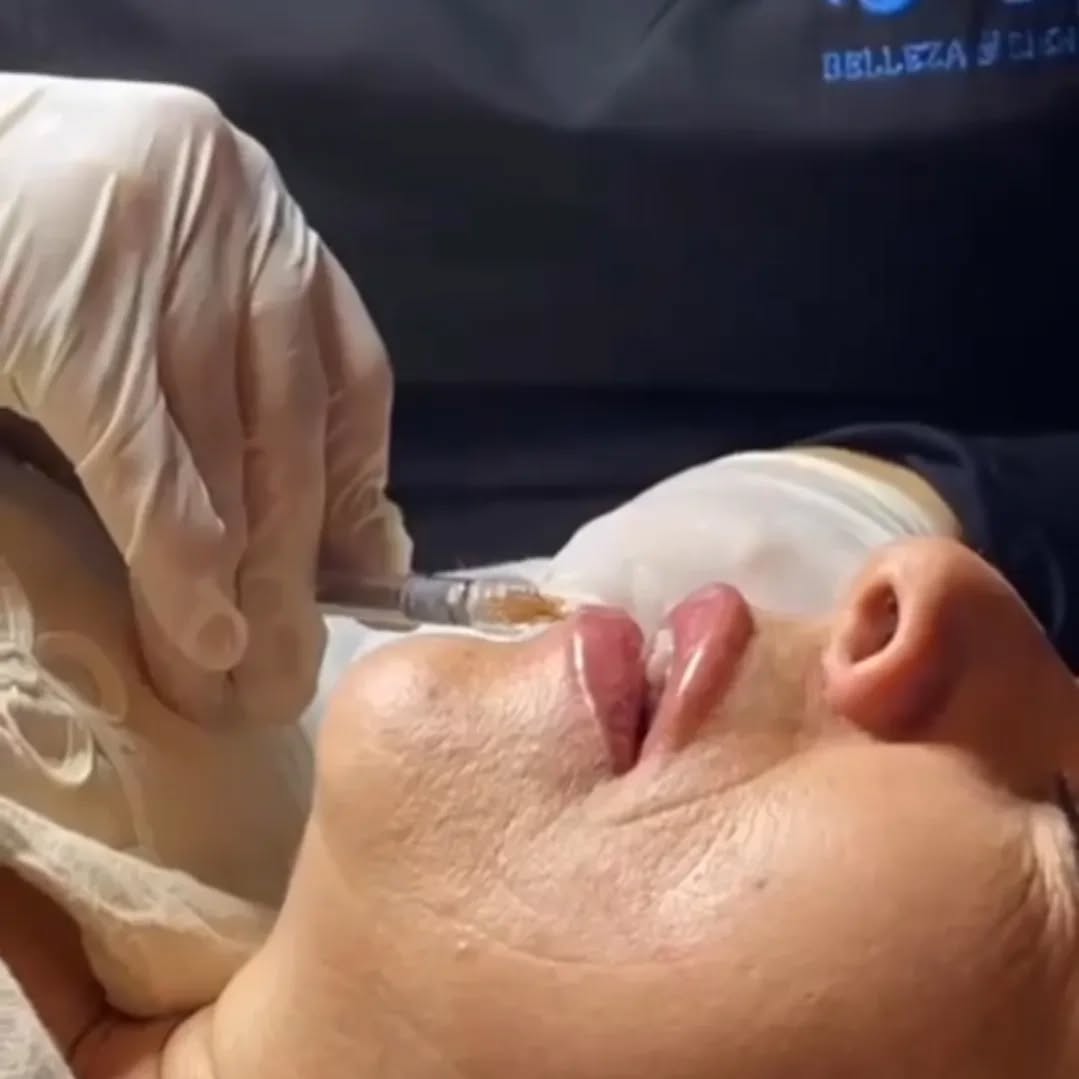 Hermoso relleno de labios!!!👄💋 Te interesa? Pregunta o haz una cita valoración sin costo ✨️💖