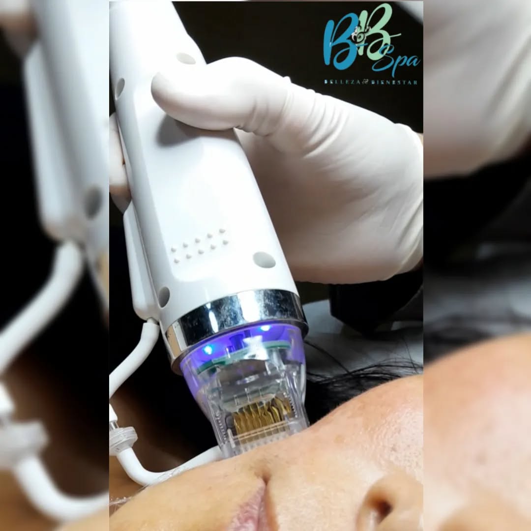 Ven y luce la piel que siempre deseaste con el novedoso tratamiento de radiofrecuencia fraccionado !!!
Este además de reafirmar & regenerar tejidos es excelente para desvanecer e incluso eliminar problemas de :
•Manchas
•Marcas de acné
•Cicatrices de quemaduras
•Arrugas y más!!!
Llama o envíanos WhatsApp al 👉(646)204*14*81
Y te atendamos una cita de evaluación completamente GRATIS ✨️