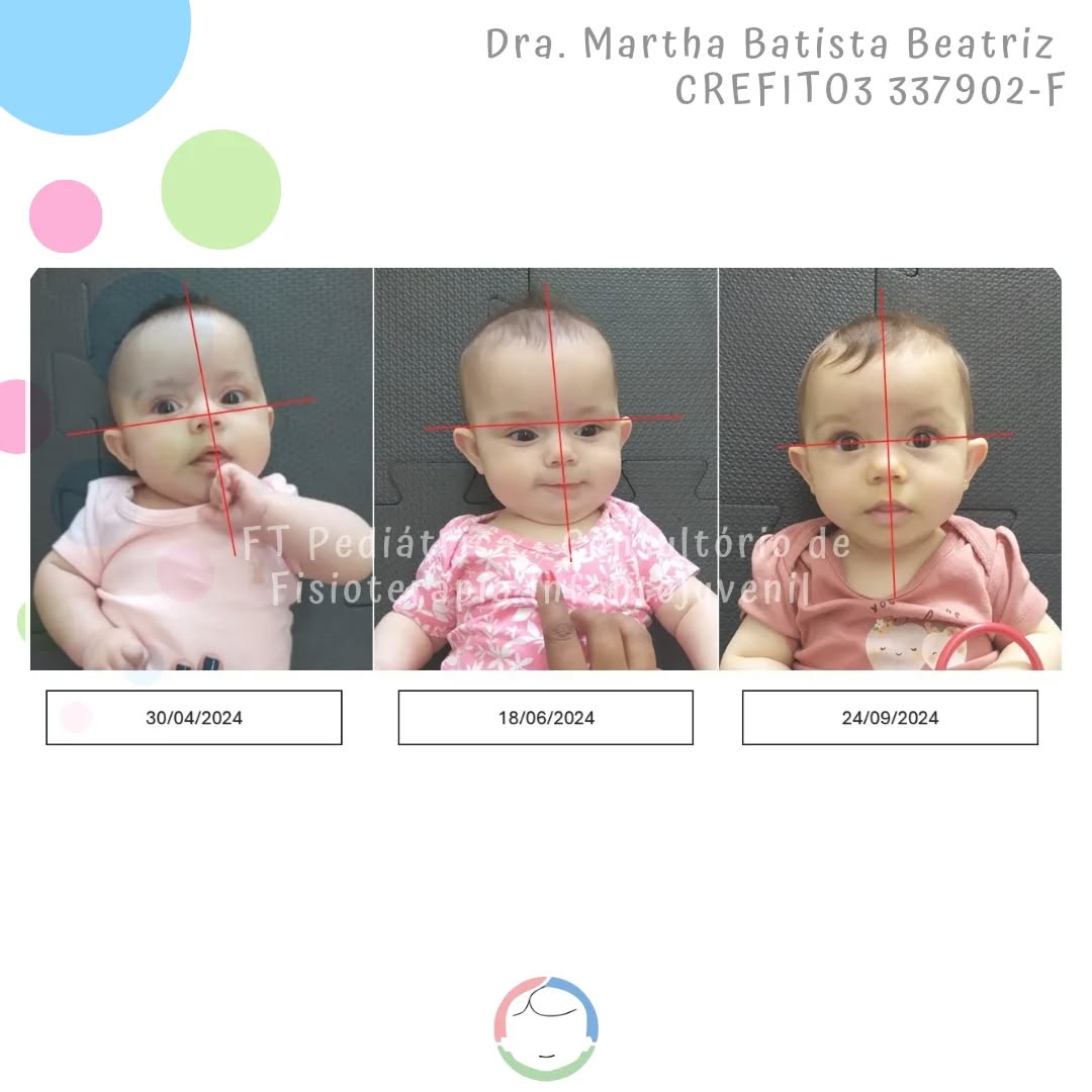 Mais uma bebê livre para crescer sem limitações, sem torcicolo e sem assimetria.
Fisioterapeuta @fisiomartha_bbeatriz
Método De Setti (em formação)
@carolinadesetti