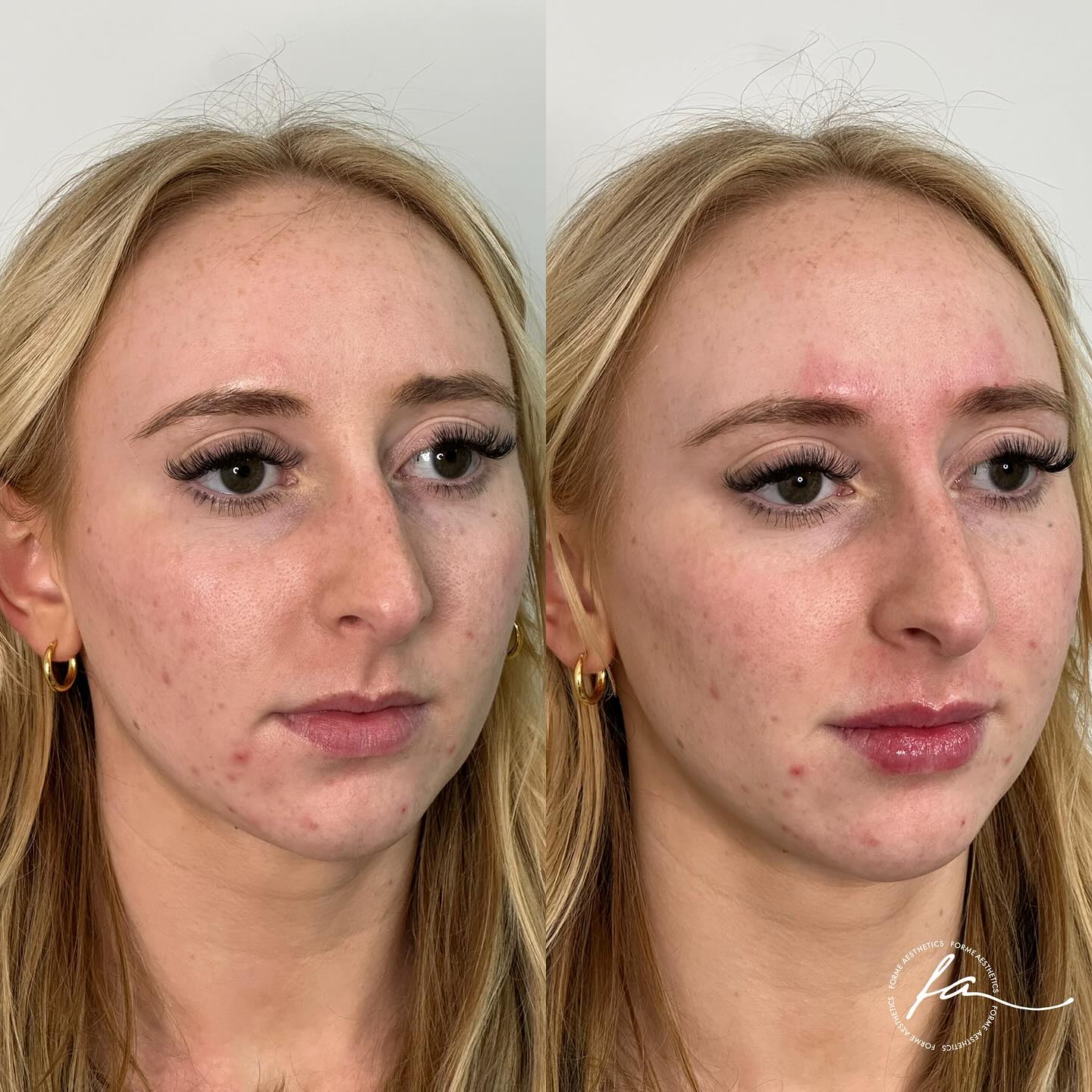 Consultations are available to discuss beautification treatments.
Any surgical or invasive procedure carries risks. Before proceeding, you should seek
a second opinion from an appropriately qualified health practitioner. Results vary.
Consent is always obtained before sharing patient images.
Treatment performed by Stephanie Sirillas RN