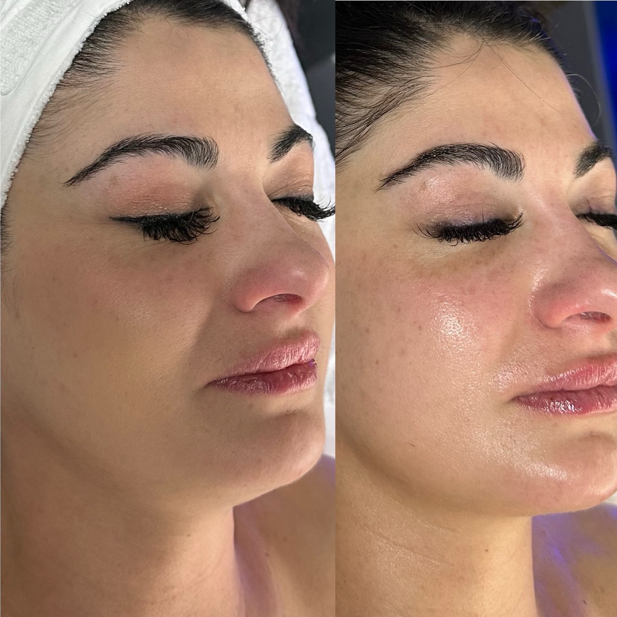 That post Platinum Hydrafacial glow 🤩
.
.
Give your mom the gift of glowing skin with the platinum hydrafacial this Mother’s Day. Buy 3 get 1 free!
.
.
#hydrafacial #hydrafacials #skinhealth #skincare #selfcare #platinumhydrafacial #idealskin #skinhealth #facials