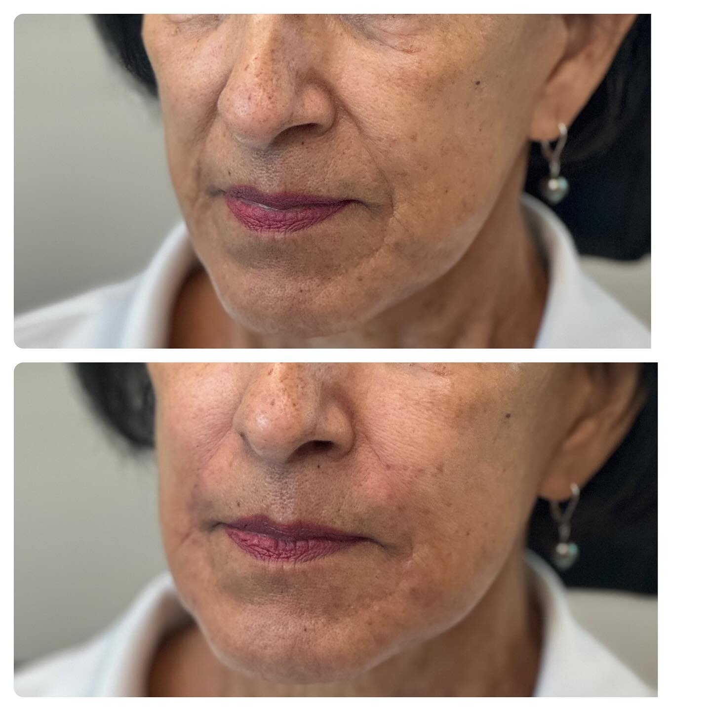 I 🩷 her results! What a beauty 💕
.
We lifted the lower face with 3 syringes of Juvederm. Her results will last between 12 -24 months. Photos are taken immediately before & after. Minor swelling & redness present. Full results at 2 weeks. 45 minutes in office
.
#cloudnineclinic #juvederm #restylane #reclaiming #botoxcosmetic #botoxhighlandsranch #dysport
.
Cloud Nine Clinic: Medical Spa
9330 S University Blvd. suite 220
Highlands Ranch Co 80129
720 360 5383 (call or text) 🤍