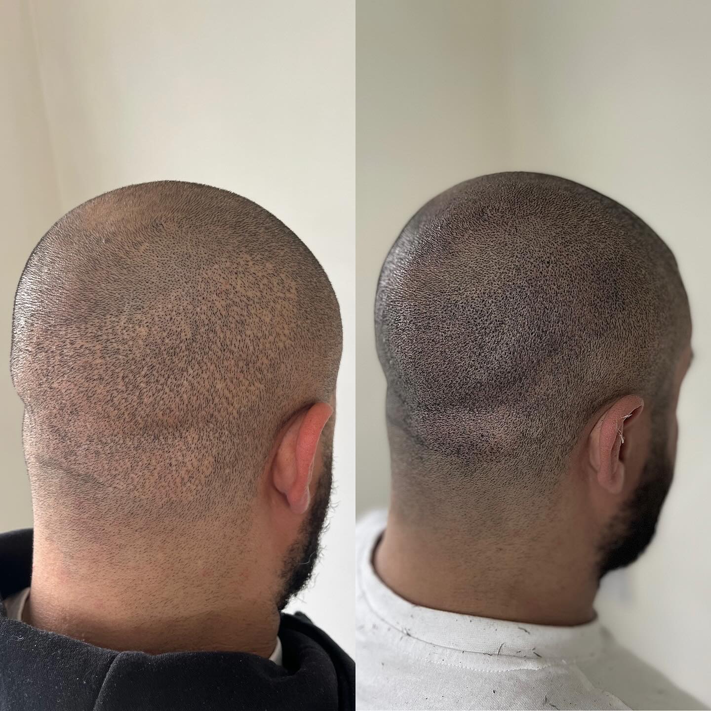 SCAR CAMOFLAUGE
Common over harvest on a ‘scarless’ transplant!
SMP (Scalp Micropigmentation) is an unmatched treatment for covering and concealing FUE and FUT transplant acars
DM for more information
📍Suffolk & Brighton, UK
🕸️www.skinheadsmp.co.uk
#smp #scalpmicropigmentation #hairtransplant #fuetransplant #scarcamouflage #scarcoveruptattoo #scar #menshair #hairloss #hairgrowth #hairlinerestoration #hairlinetattoo