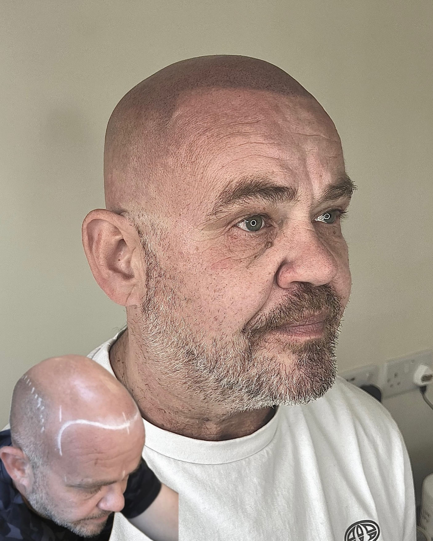 TRANSFORMATION
Regain your confidence with SMP
#scalpmicropigmentation #smp #hairloss #menshair #shave #buzzcut #recedinghairline #hairgrowth #hairtransplant #hairtattoo #scalptattoo #hairtransformation #hairideas