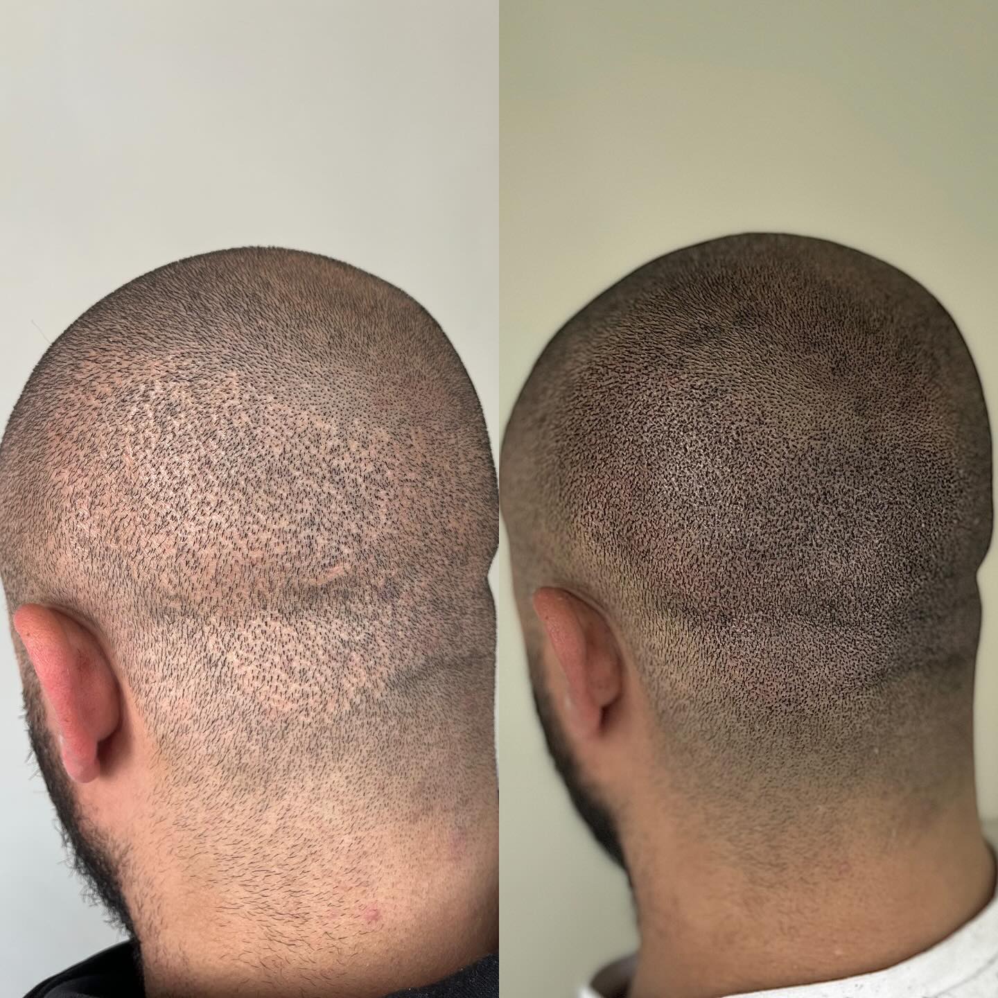 TRANSPLANT SCARS
SMP (SCALP MICRO-PIGMENTATION) IS PERFECT FOR SCAR COVERAGE!
People often think it’s one or the other, SMP or a hair transplant for a hair loss solution, however, if you’re looking for the best results you should combine the two!
Above is the result of a FUE ‘SCARLESS’ TRANSPLANT, even if you grow your hair long at the back there is noticeably less density. When you are sold your dream hair by surgeons, they often miss out the part where you can no longer have a skin fade as there are hundreds of dot scars at the back, affecting confidence again!
Combine SMP to thicken up transplanted hair to add more density and use it at the back for FUE or FUT scar camouflage
📍Suffolk & Brighton clinics, UK
🕸️www.skinheadsmp.co.uk
📧skinheadsmp@gmail.com
📨Instagram DM
⭐️5 Star Google reviews
#scarcamouflage #scartreatment #scarcoveruptattoo #scarcoverup #scarcover #transplantscar #hairtransplant #fuescar #futscar #fuetransplant #smp #scalpmicropigmentation #cosmetictattoo #hairloss #hairfollicles #newhair #menshair #confidence #hairsurgery #hairtransplantturkey #hairtransplantation #hairtransplantsurgery #hairtransplantistanbul