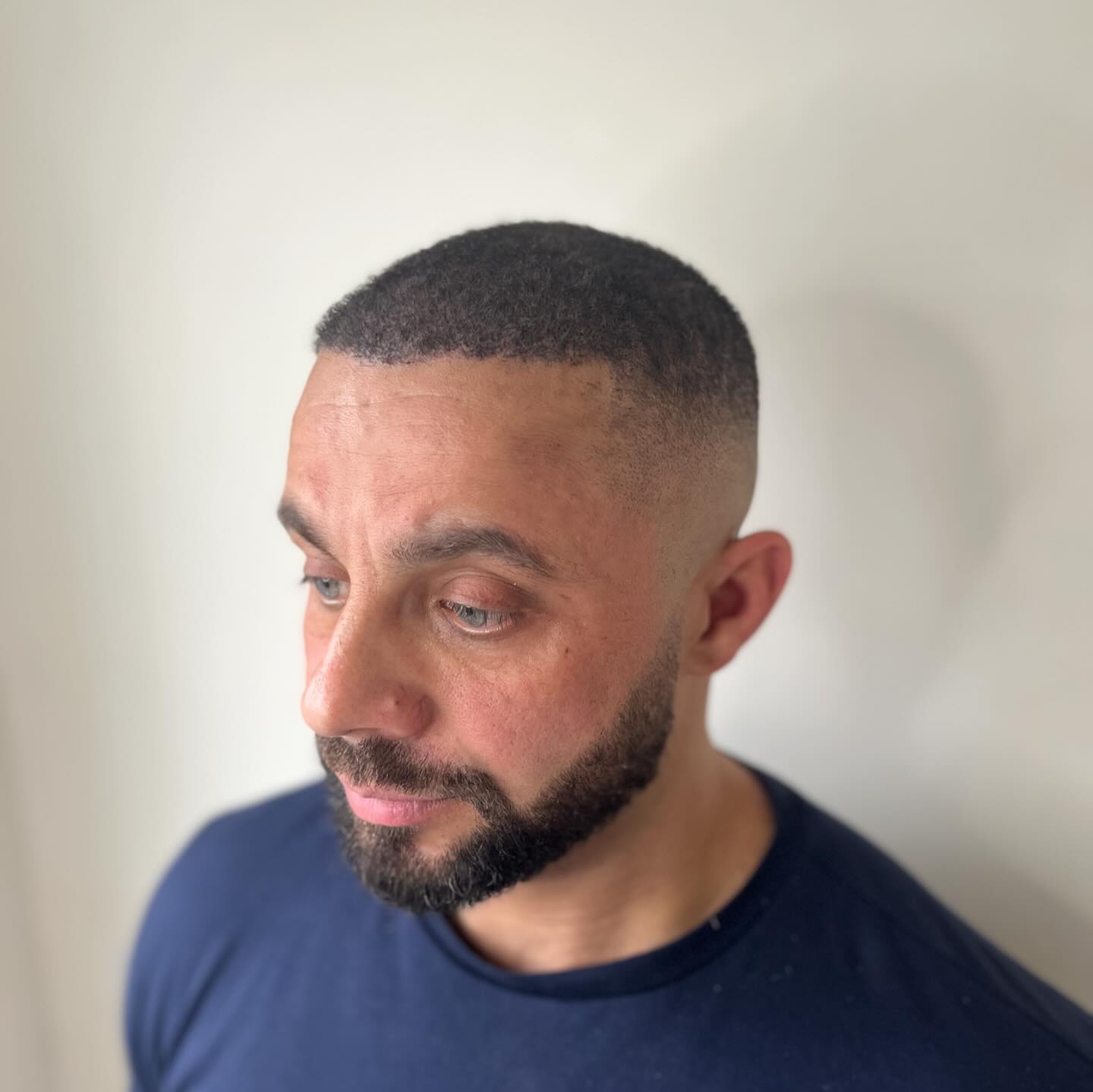 DENSITY TREATMENT
Thickening up a transplant with Scalp Micro-Pigmentation (SMP)
Some people think it’s a choice between hair transplant or SMP, however at Skinhead SMP we would never advise against a transplant if your mind was set on it, we encourage both!
I have advised people to try SMP first, the hairline itself even with a shaved head makes such a difference, you look younger and boosts confidence! They often no longer want a transplant.
However, if you get a transplant after SMP, it doesn’t effect the cosmetic tattoo and grows through it, actually helping conceal the scalp through the long healing and shedding stages.
Swipe for before pics!
Get in touch with us today to see how Scalp Micro-Pigmentation (SMP) can help you put a stop to hair loss
🕸www.skinheadsmp.co.uk
💻skinheadsmp@gmail.com
📍Bury St Ed’s, Suffolk & Brighton clinics, UK
⭐️5 star Google reviews
💯Customer satisfaction
Recommended by barbers, hairdressers, tattoo artists and more in local areas
Specialists in Scalp Micropigmentation
#smp #hairloss #scalptattoo #hairtattoo #micropigmentation #hairlosstreatment #hairlosssolution #hairtransplant #alopecia #hairgoals #scalppigmentation #hairlinetattoo #hairline #thinninghair #scalp #hairgrowth #tattoo #hairregrowth #scalpmicropigmentationtraining #hair #bald #hairtransformation #hairlosshelp #cosmetictattoo #hairrestoration #menshair #barber #scalptattooing #scalptreatment #scalpmicropigmentation