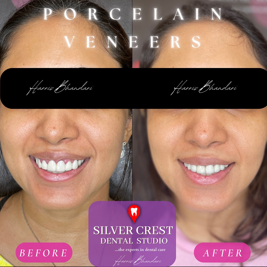 Subtle, yet striking! 🤩
Unveiling a gentle shift towards :
• Improved Gum Health
• Balanced Smile Proportions
• Enhanced Lip Profile
A full replacement set, consisting of Veneers + Crowns helped our gorgeous patient achieve her smile goals, in under 10 days.
#smilegoals #smilemore #porcelainveneers #emax #veneers #crowns #porcelaincrowns #smiletransformation #smilemakeover #teethwhitening #gumlift #cosmeticdentistry #aesthetics #instagood