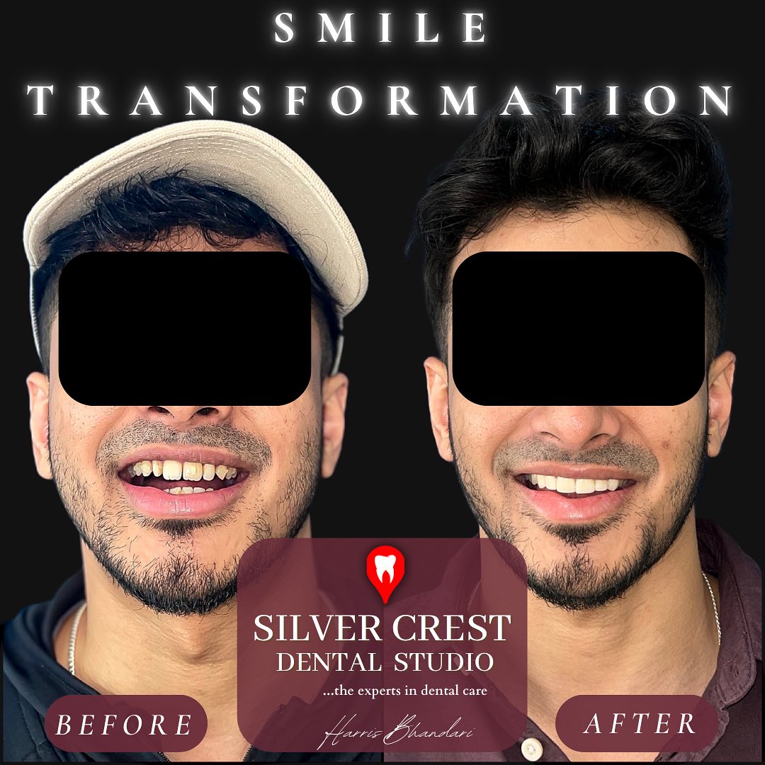 “A bespoke smile, curated to last a lifetime” 📸✨
A quick, efficient and painless smile makeover achieved using a simple set of 6 veneers for our patient, Mr A, to help elevate his overall look. DM us today to start your smile journey!
#porcelain #veneers #smilemakeover #smilechallenge #smiles #smilemore #smiletransformation #veneers_smile #veneersbysilvercrest #dentistsofig #instadentist #instagram #dentaloffice #dentalveneers #dentalart