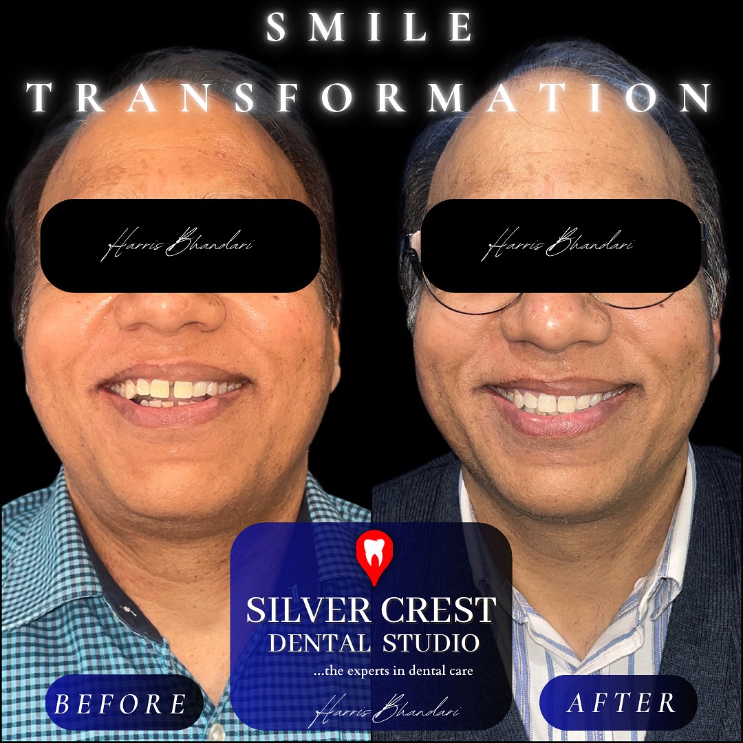 ✨Aligning confidence with every smile ✨
A round of Clear Aligners with a dash of home whitening yields wonders.
DM us to know more! 💖
#crookedteeth #gaps #clearaligners #aligners #kiyoclear #aligning #teeth #aestheticdentistry #cosmetic #straightteeth #teethwhitening #smilebright #teethcleaning #teethgoals #smilemakeover #smilemore