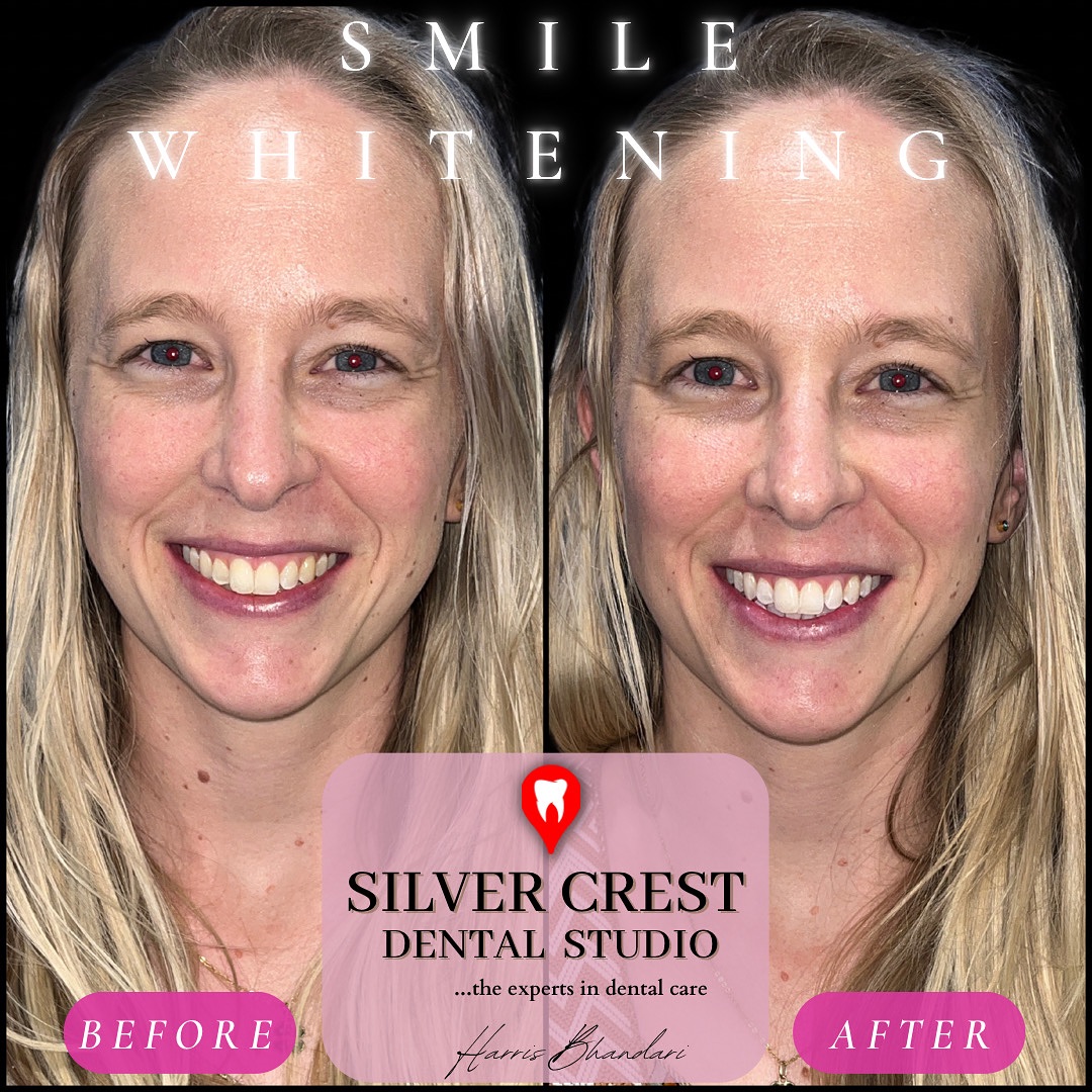 45 minutes. No pain. Just the magic of gel and light 💡✨
Experience Teeth Whitening like never before. DM is to know more!
#teethwhitening #smile #teethbleaching #zoomwhitening #whitening #brightsmile #teeth #dentist #cosmeticdental #aestheticdentist #dentistsinindia #smilemakeover #whiteteeth