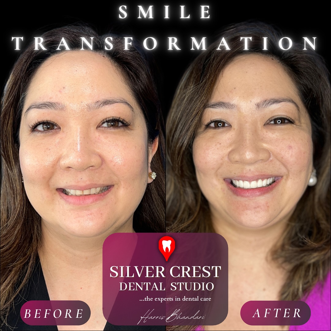 A comprehensive smile makeover done for our gorgeous patient with a combination of Ceramic Veneers + Laser Gum Recontouring 🤍✨
#smilemakeover #veneers #dentalveneers #smiletransformation #porcelainveneers #cosmeticdentistry #cosmeticdentist #aestheticdentist #aesthetics #gumcare #transformation #instareels #reelitfeelit #insta #fyp