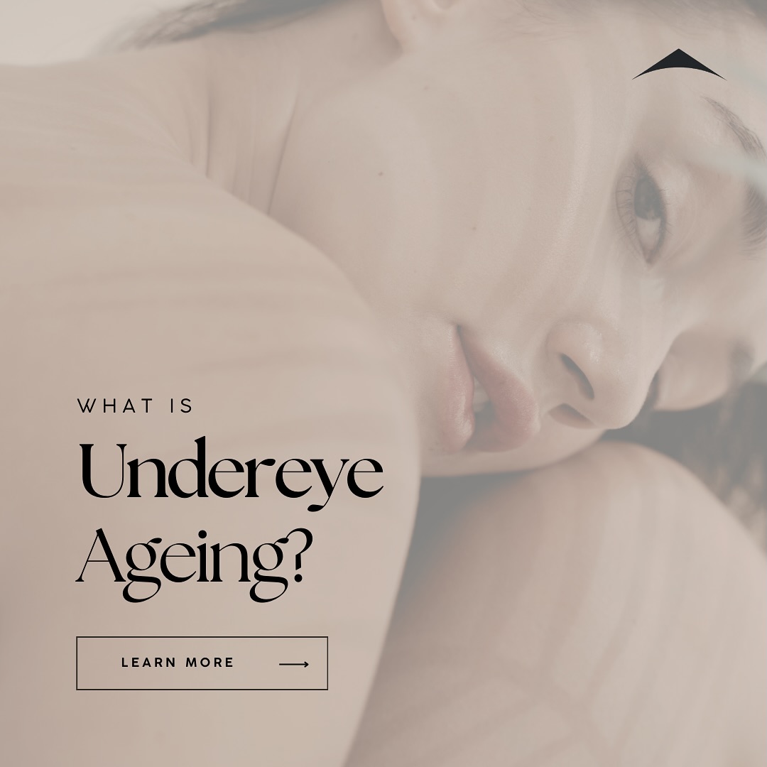 Undereye ageing is influenced by both intrinsic and extrinsic factors.
1. Intrinsic Factors:
Genetics: Genetic predisposition plays a significant role in how quickly and noticeably the skin ages.
Natural Ageing Process: As we age, the body’s production of collagen and elastin decreases, leading to reduced skin elasticity and firmness. Additionally, the rate of cell turnover slows down, resulting in thinner and more fragile skin.
Bone Structure Changes: The bones around the eyes gradually lose density and recede with age, leading to a sunken appearance and more pronounced hollows under the eyes.
2. Extrinsic Factors:
Sun Exposure: Ultraviolet (UV) radiation accelerates the breakdown of collagen and elastin, leading to premature wrinkles and pigmentation issues such as dark circles.
Smoking: Tobacco smoke contains free radicals that damage skin cells and impede blood flow, contributing to accelerated ageing.
Diet and Hydration: Poor nutrition and inadequate hydration can result in dry, dull skin and exacerbate the appearance of fine lines and wrinkles.
Sleep Patterns: Lack of sleep can cause fluid retention and increased blood flow under the eyes, resulting in puffiness and dark circles.
Stress: Chronic stress can lead to the release of cortisol, which breaks down collagen and contributes to ageing.
Understanding the causes of undereye ageing is essential for effective prevention and treatment. With a combination of healthy lifestyle choices, proper skincare, and advanced cosmetic treatments, it is possible to maintain a youthful and vibrant appearance around the eyes.
#darkcircles #darkcirclestreatment #puffinessundereyes #crowsfeet #wrinkles #crepeyskin #undereyebags #undereyetreatment