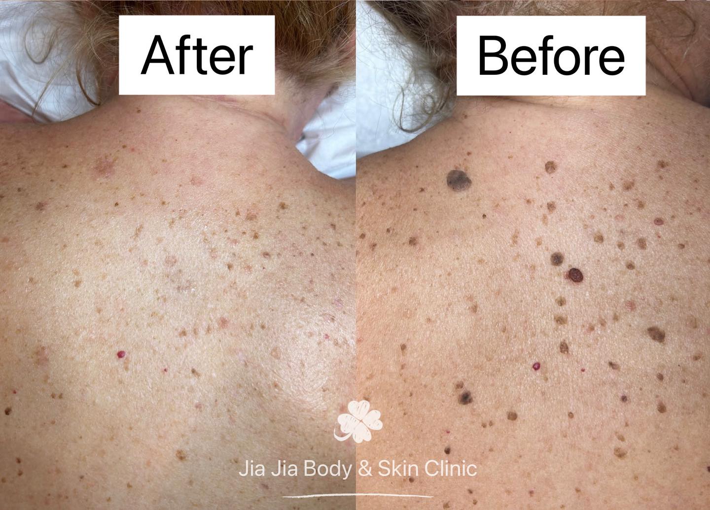 Skin Tag Removal at Our Clinic
Struggling with skin tags? Our clinic offers expert care for safe and effective removal.
Consultation: Begin with a professional evaluation to confirm your skin tags and discuss the best approach for removal.
Personalized Care: Our team will guide you through the process, ensuring you receive tailored advice and support.
Aftercare: We offer detailed aftercare instructions to help you heal properly and avoid complications.
For expert skin tag removal, schedule your consultation with us today!
#SkinTagRemoval #Dermatology #ClinicCare #SkinHealth #CosmeticDermatology #HealthySkin #ExpertCare #MedicalConsultation #SkinTagRemovalClinic
#jiajiabodyandskinclinic