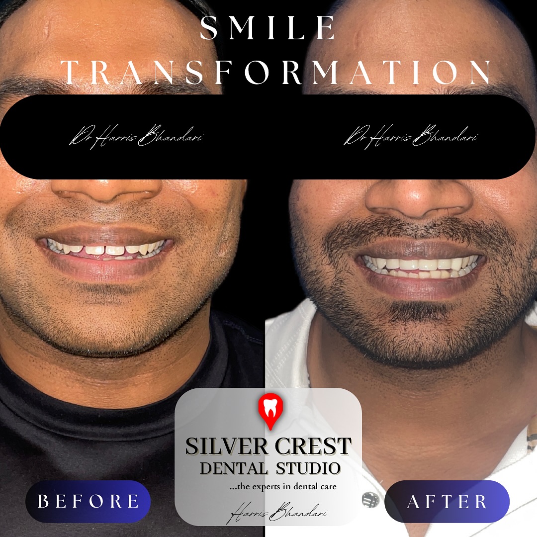 An extreme smile transformation 🤍
Achieved with a combination of Aligners + Veneers to attain a healthy, well aligned and great looking smile!
Sign up to our Platinum Package today to avail similar benefits for your smile!
#smilemakeover #smilemore #porcelainveneers #veneers #dentalveneers #clearaligners #kiyoclear #invisalign #aligners #teethalignment #whitening #teeth #toothgap #smiletransformation