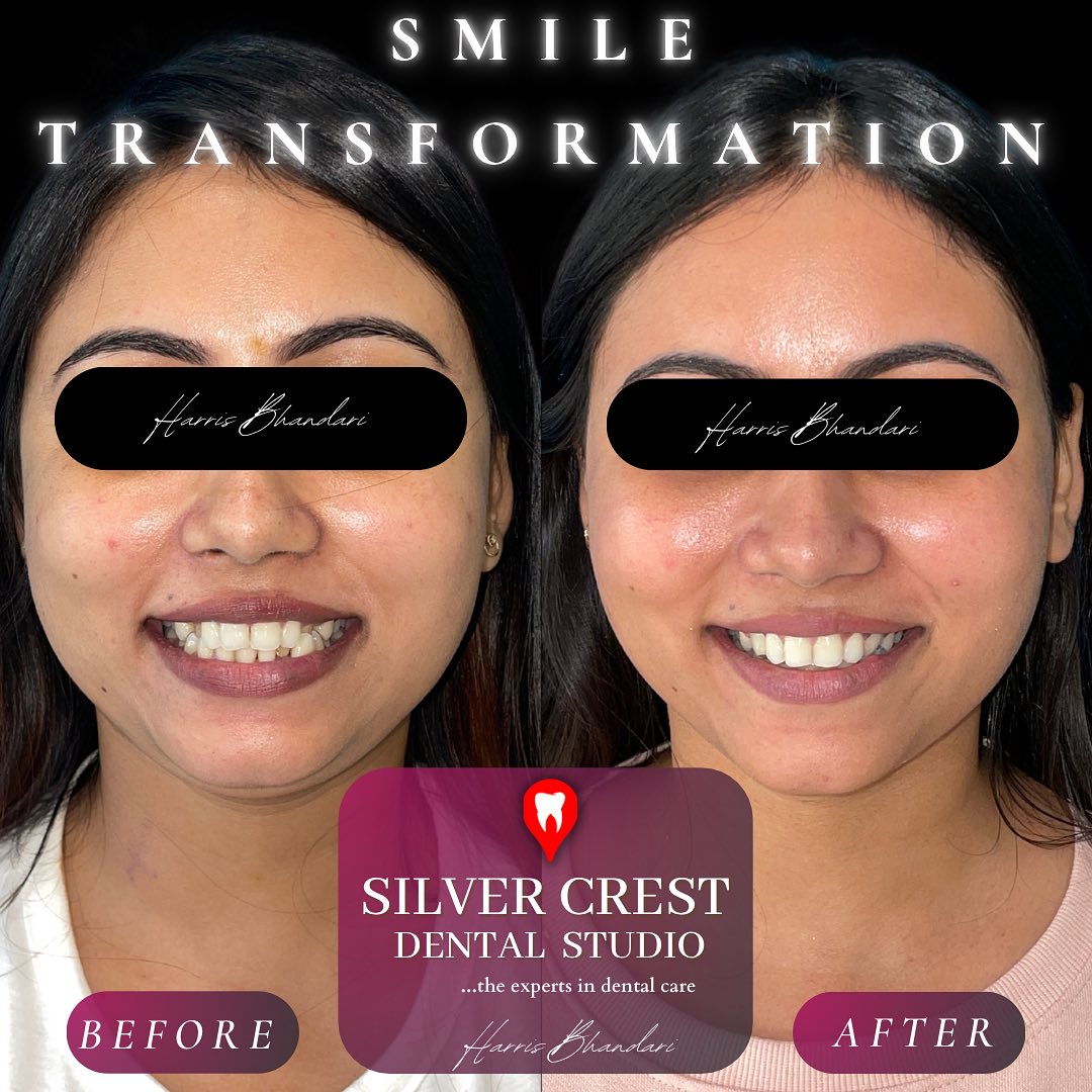 “A makeover for the ages” ✨
An extreme smile transformation, brought forth with a combination of Clear Aligners and Composite Bonding for a seamless smile achieved in the most natural way possible.
DM to start your aligner journey with us today ✨🔥
#clearaligners #orthodontics #smilemakeovers #teeth #aligners #smiledesign #cosmetics #dentistry #invisalign #kiyoclear #invisiblealigners #compositebonding #composite #bonding #compositeveneers #veneers #smiledesign #smile