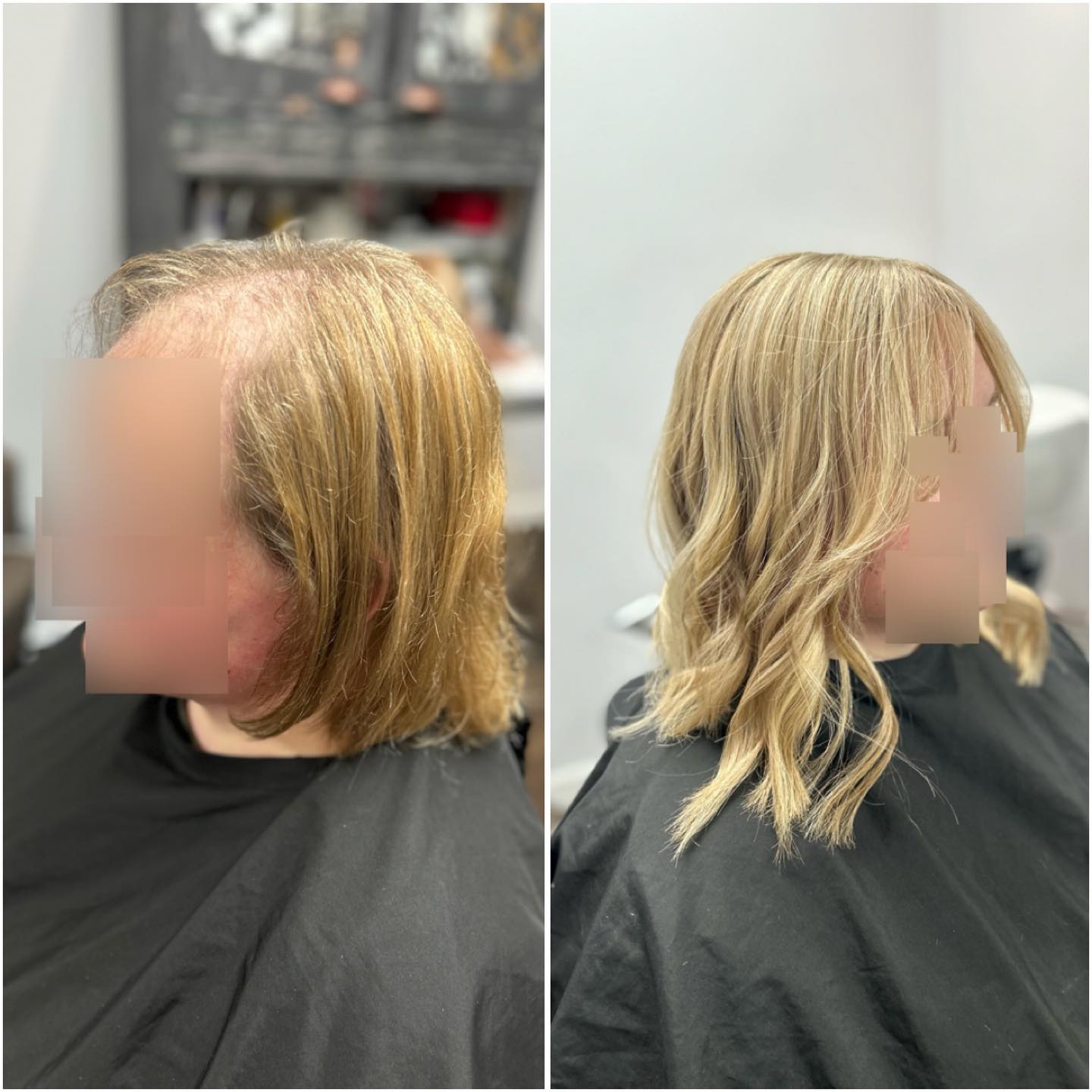 Yesterday I created this system for this young lady, here are her before and after pictures. I spoke to her today to see how she was getting on with her results and she is in love with her new hair and told me it’s given her a great confidence boost. ❤️
PCOS (Polycystic Ovary Syndrome) is a condition affecting women, this can affect their hair as they can have higher levels of androgens (male hormones) These androgens are problematic causing hair loss, presenting itself as Female Pattern Hair Loss.
.
.
.
.
#lacetopwigs #lacefrontwigs #lacewigs #wigs #lacefrontal #alopecia #areata #hairloss #hairreplacements #bespokewigs #customcolouredwigs #handmadewigs #wigbuilding #hairintegration #laceintegration #hairextensions #weave #hairlossspecialist #trichologist #trichology #hairlosssolution #hairlosssalon #pcos #polycysticovariansyndrome